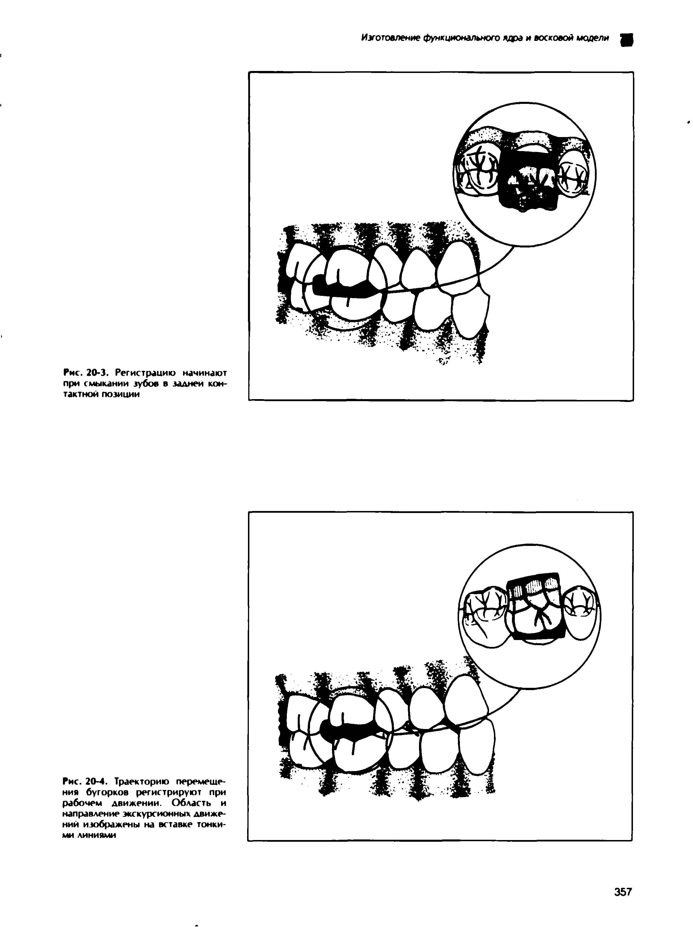 Рис. 20-3. Регистрацию начинают при смыкании зубов в задней контактной позиции...