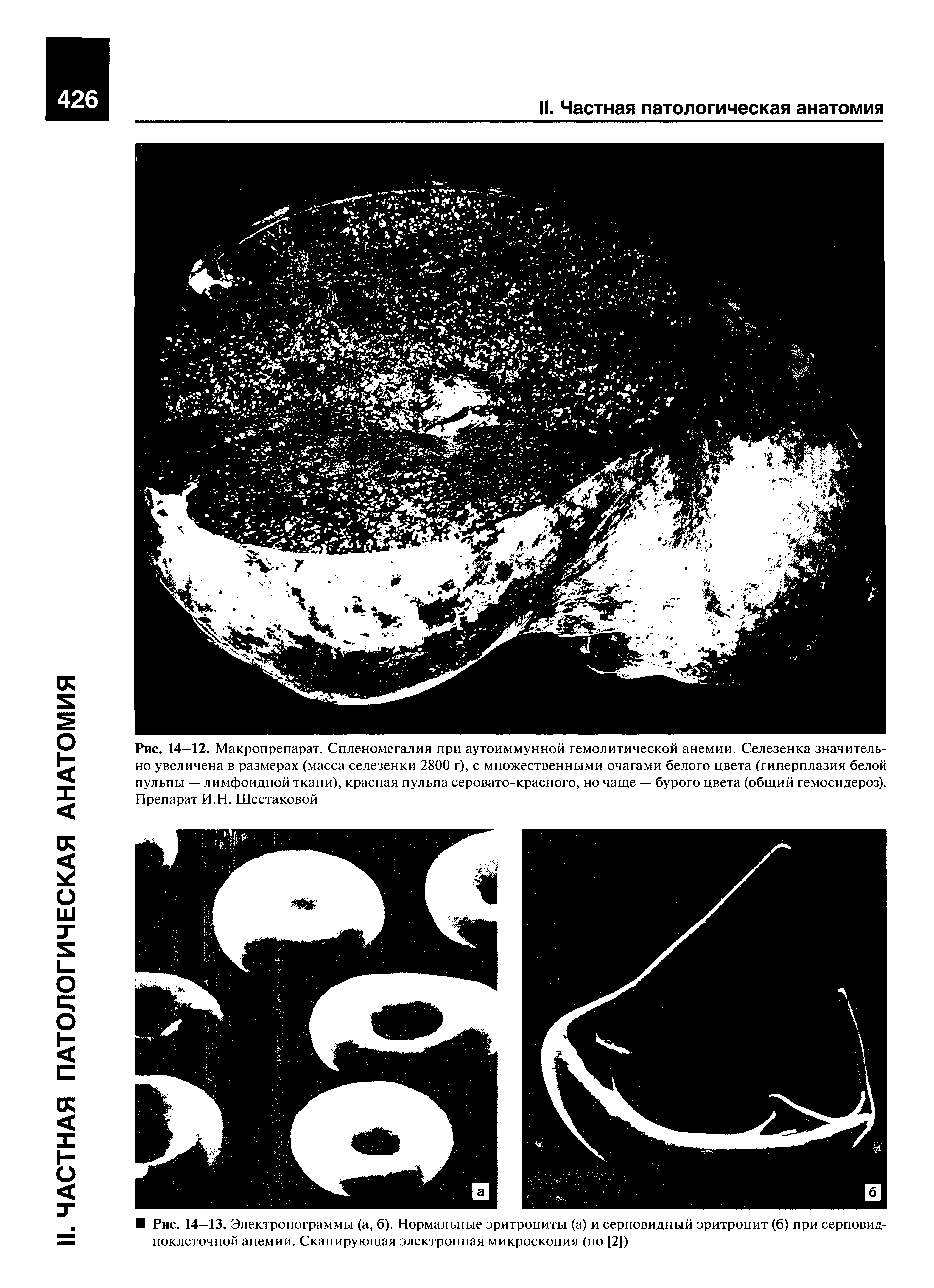 Рис. 14—12. Макропрепарат. Спленомегалия при аутоиммунной гемолитической анемии. Селезенка значительно увеличена в размерах (масса селезенки 2800 г), с множественными очагами белого цвета (гиперплазия белой пульпы — лимфоидной ткани), красная пульпа серовато-красного, но чаще — бурого цвета (общий гемосидероз). Препарат И.Н. Шестаковой...