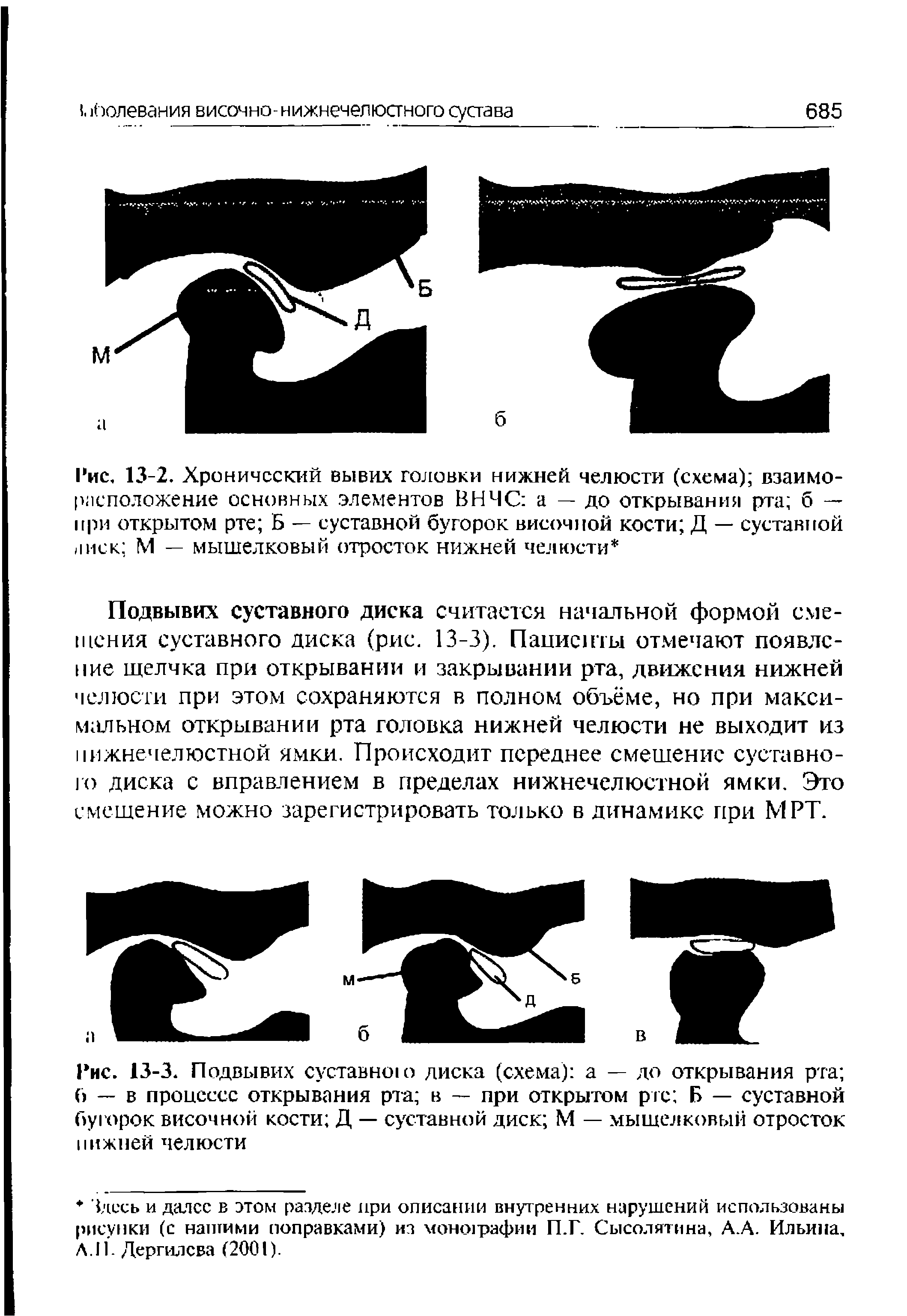 Рис. 13-2. Хронический вывих головки нижней челюсти (схема) взаиморасположение основных элементов ВНЧС а — до открывания рта б — при открытом рте Б — суставной бугорок височной кости Д — суставной л иск М — мыщелковый отросток нижней челюсти ...