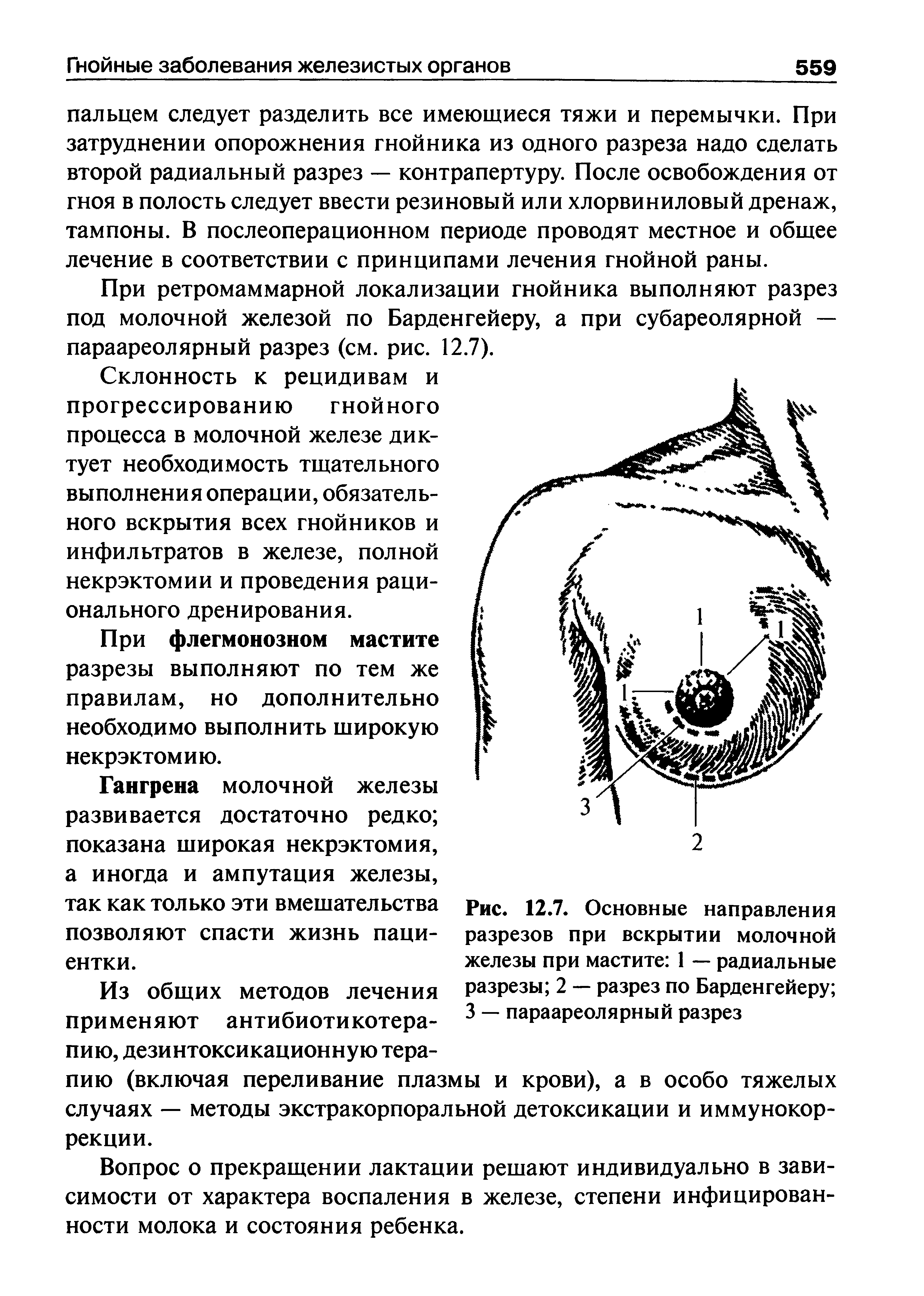 Рис. 12.7. Основные направления разрезов при вскрытии молочной железы при мастите 1 — радиальные разрезы 2 — разрез по Барденгейеру 3 — параареолярный разрез...