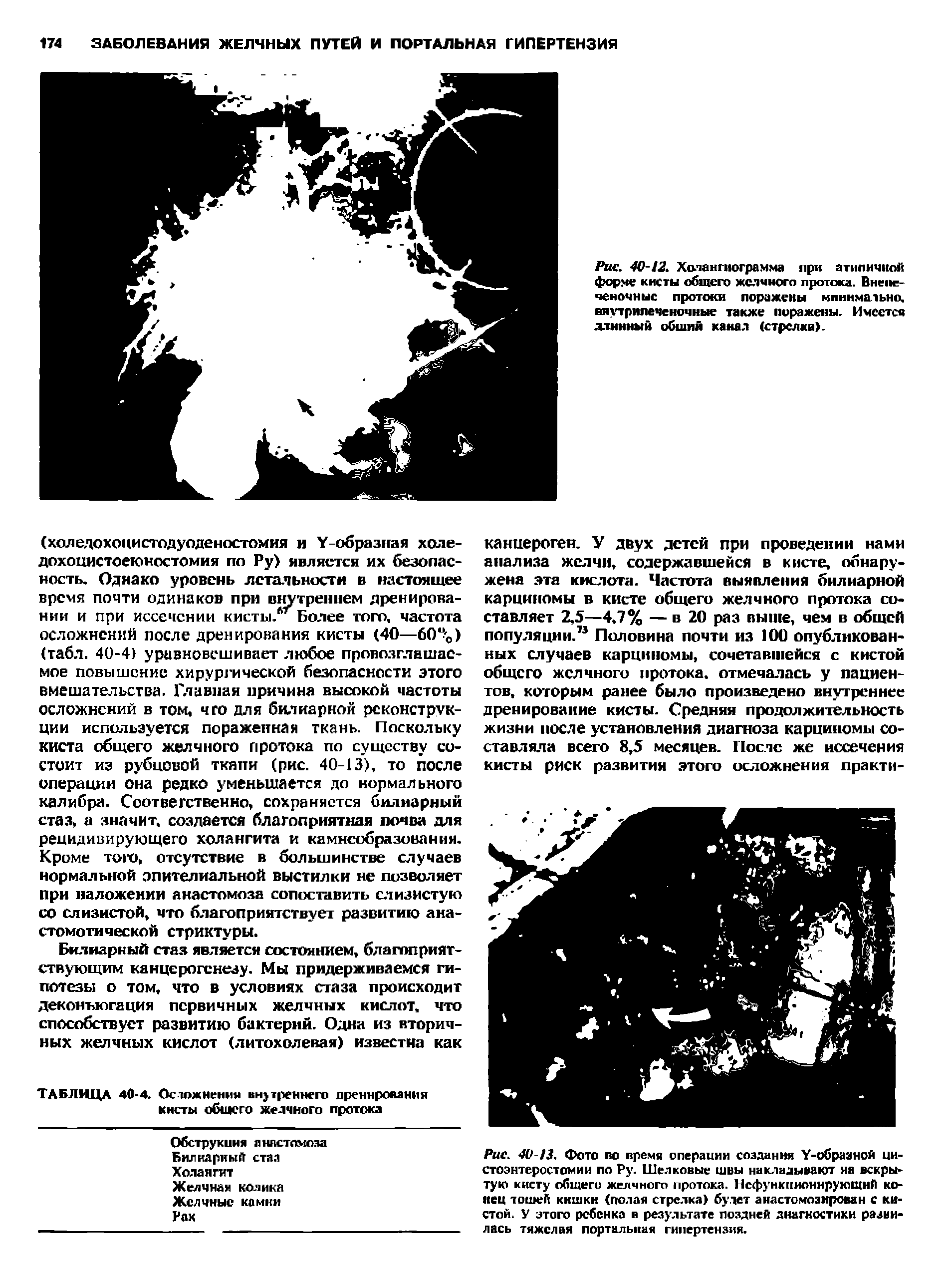 Рис. 40-12. Холангиограмма при атипичной форме кисты общего желчного протока. Внепеченочные протоки поражены минимально, внутрнлеченочные также поражены. Имеется длинный обшин канал (стрелка).