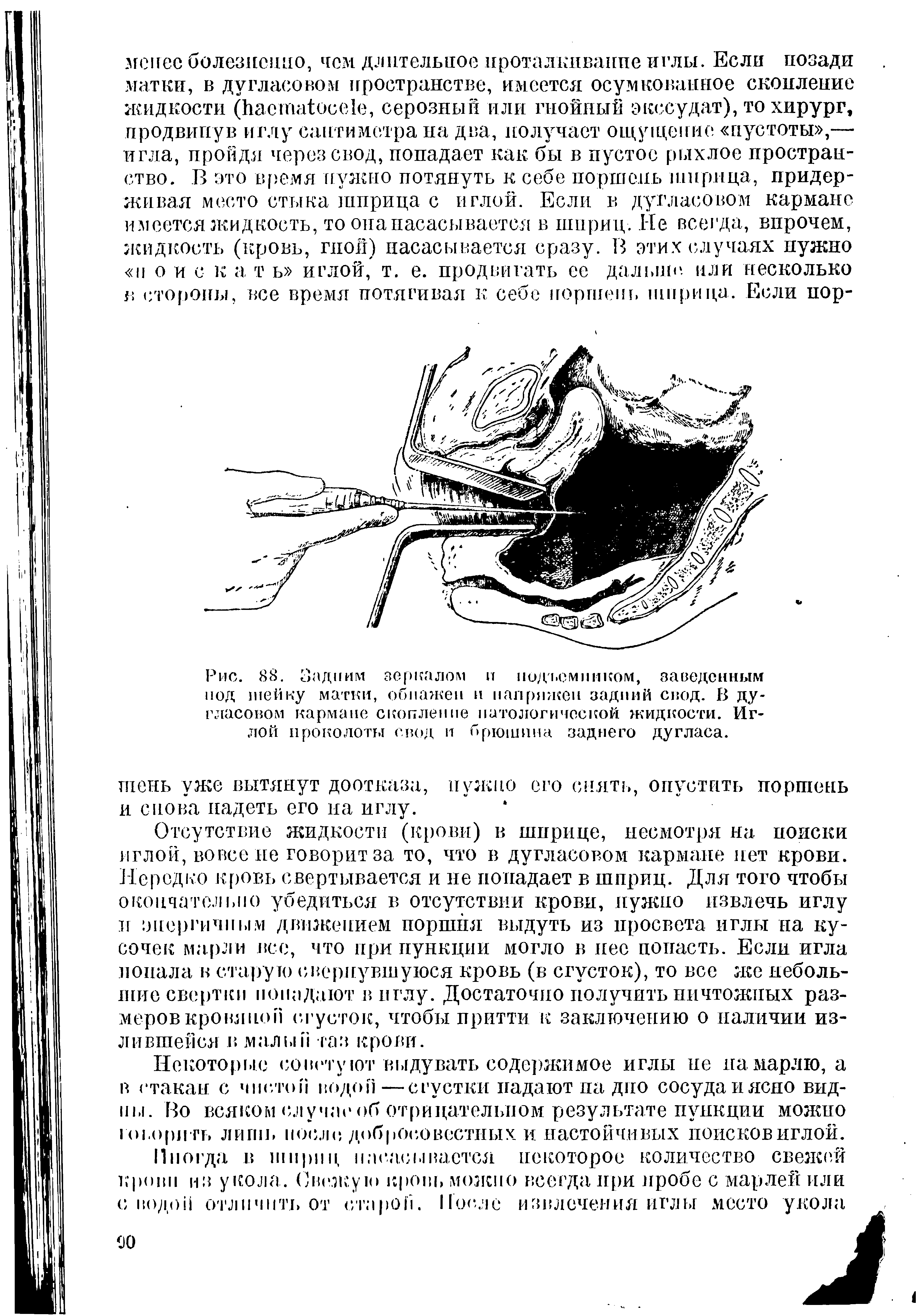 Рис. 8<8. Задним зеркалом и подъемником, заведенным под шейку матки, обнажен и напряжен задний свод. В дугласовом кармане скопление патологической жидкости. Иглой проколоты свод и брюшина заднего Дугласа.