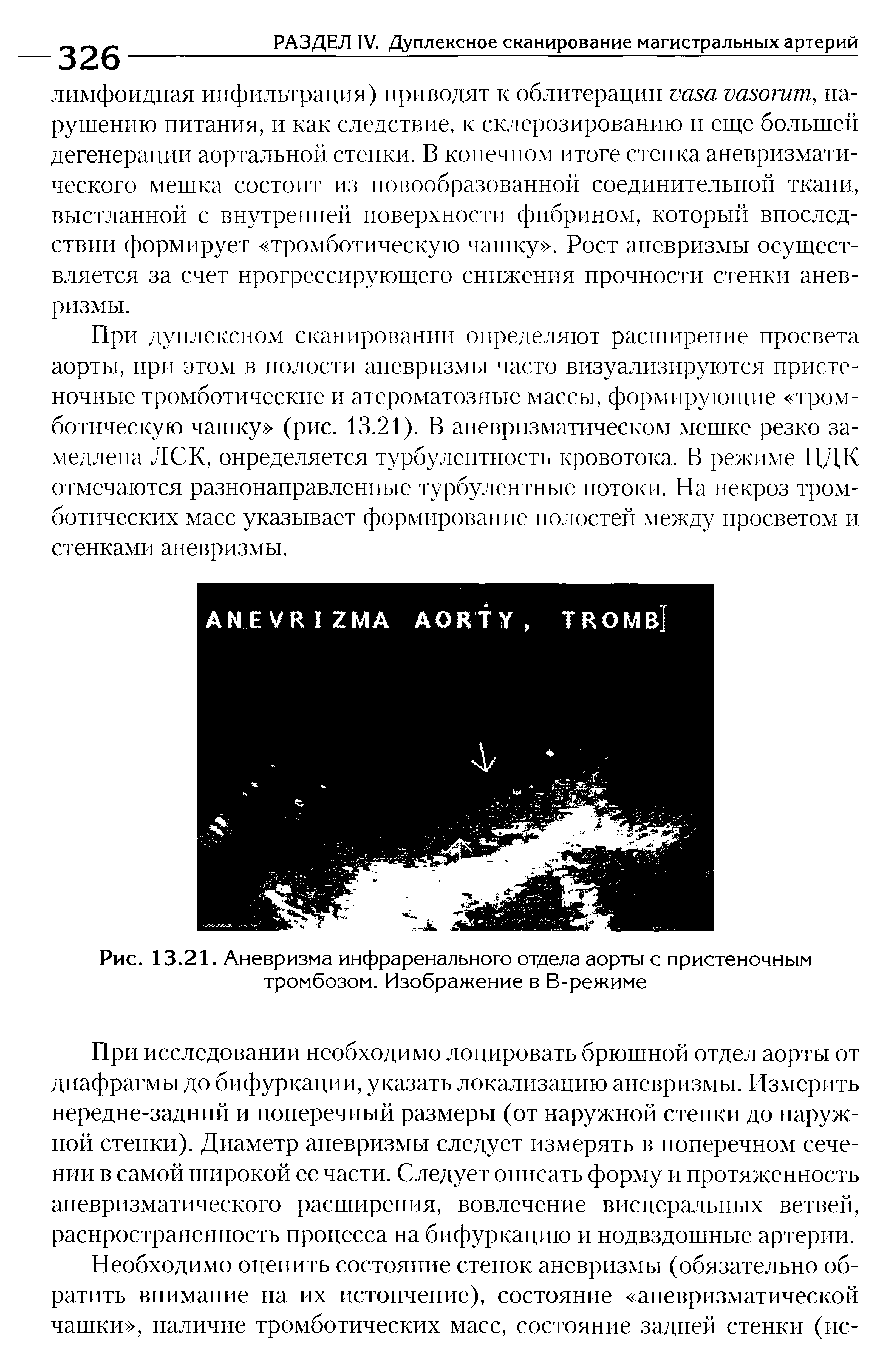 Рис. 13.21. Аневризма инфраренального отдела аорты с пристеночным тромбозом. Изображение в В-режиме...