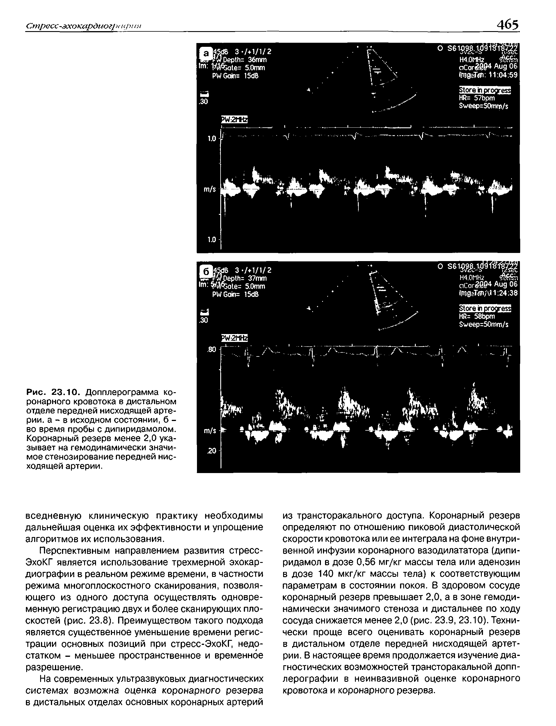 Рис. 23.10. Допплерограмма коронарного кровотока в дистальном отделе передней нисходящей артерии. а - в исходном состоянии, б -во время пробы с дипиридамолом. Коронарный резерв менее 2,0 указывает на гемодинамически значимое стенозирование передней нисходящей артерии.