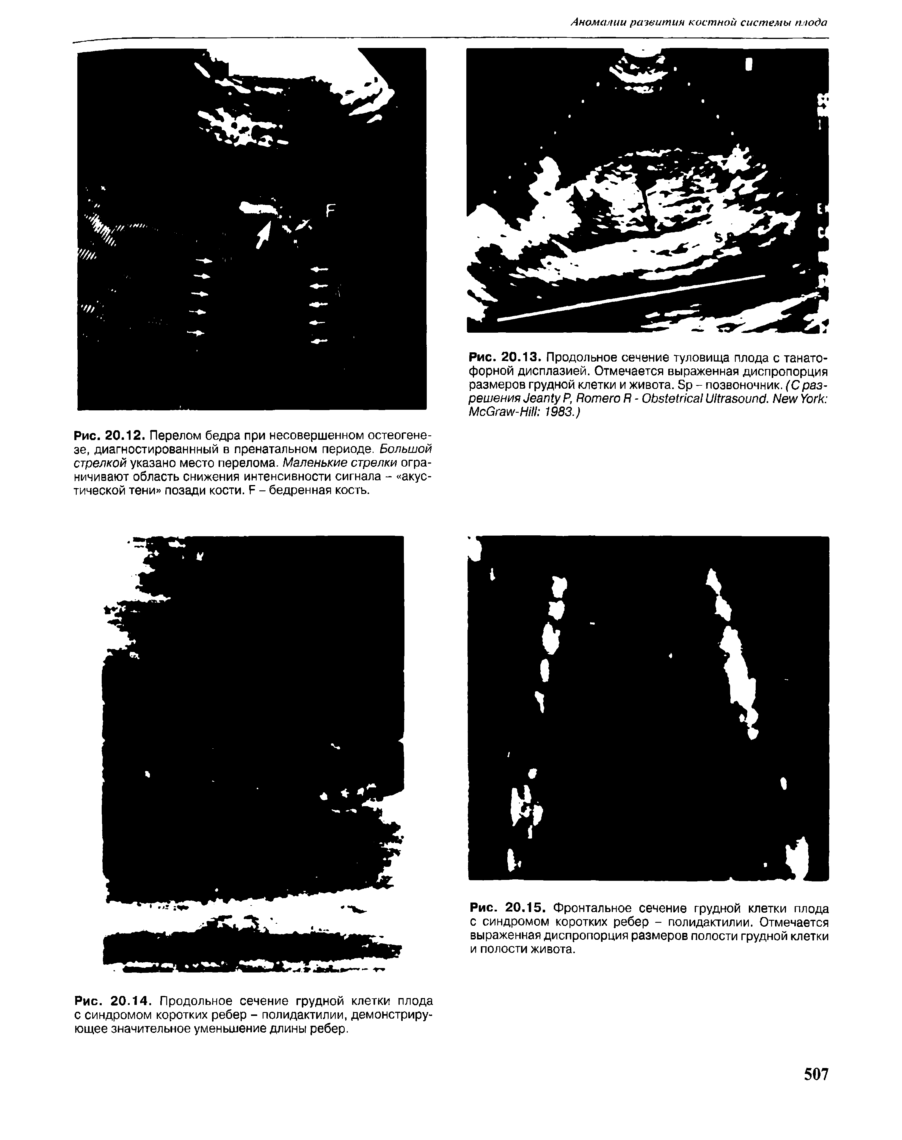 Рис. 20.13. Продольное сечение туловища плода с танатофорной дисплазией. Отмечается выраженная диспропорция размеров грудной клетки и живота. S - позвоночник. (Сразрешения J Р, R R - O U . N Y M G -H 1983.)...