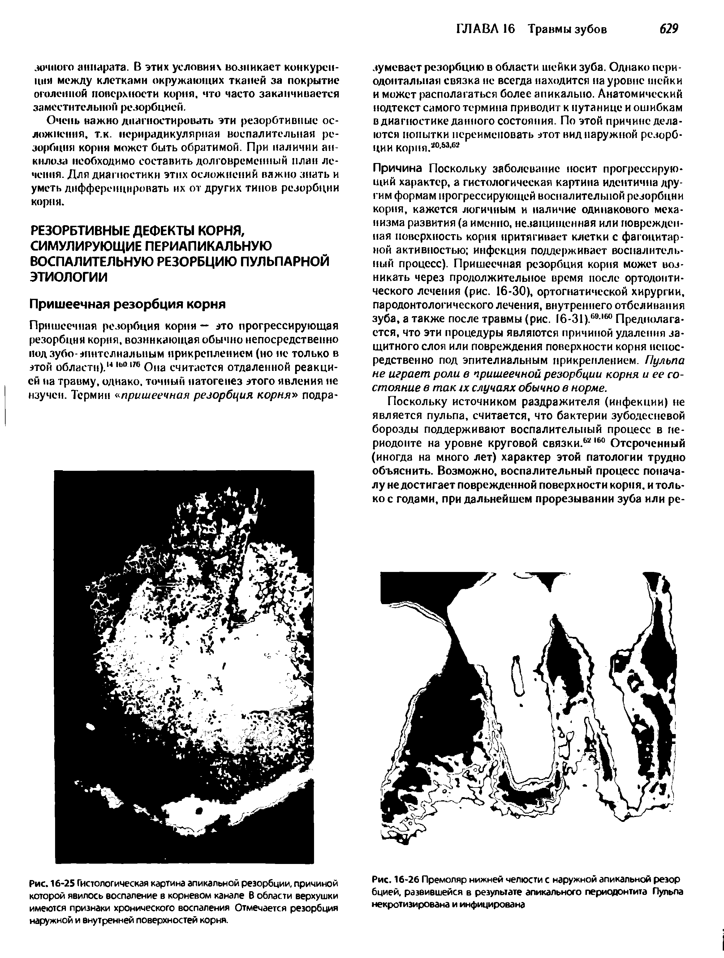 Рис. 16-26 Премоляр нижней челюсти с наружной апикальной резор бцией, развившейся в результате апикального периодонтита Пульпа некротизирована и инфицирована...