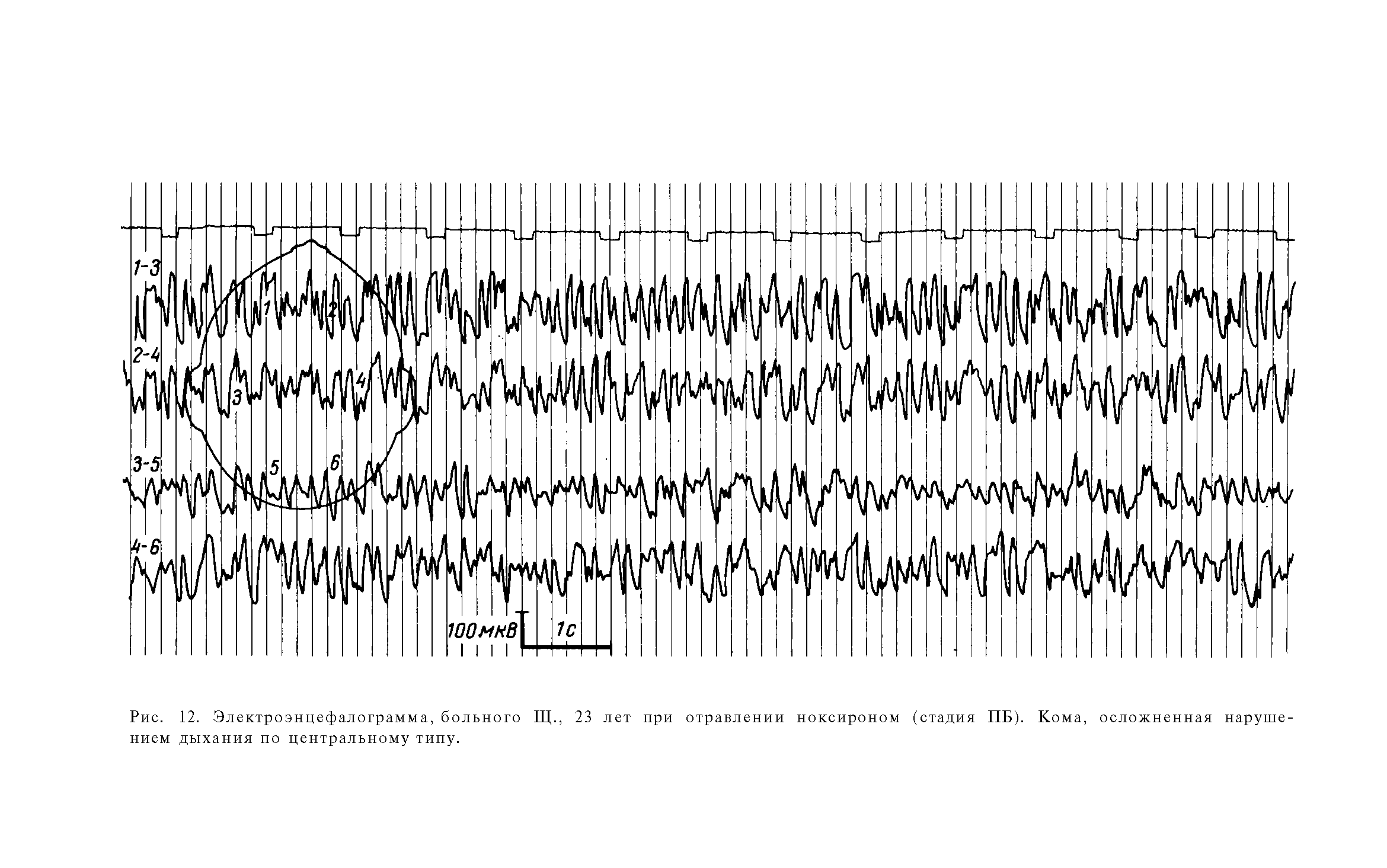 Рис. 12. Электроэнцефалограмма, больного Щ., 23 лет при отравлении ноксироном (стадия ПБ). Кома, осложненная нарушением дыхания по центральному типу.