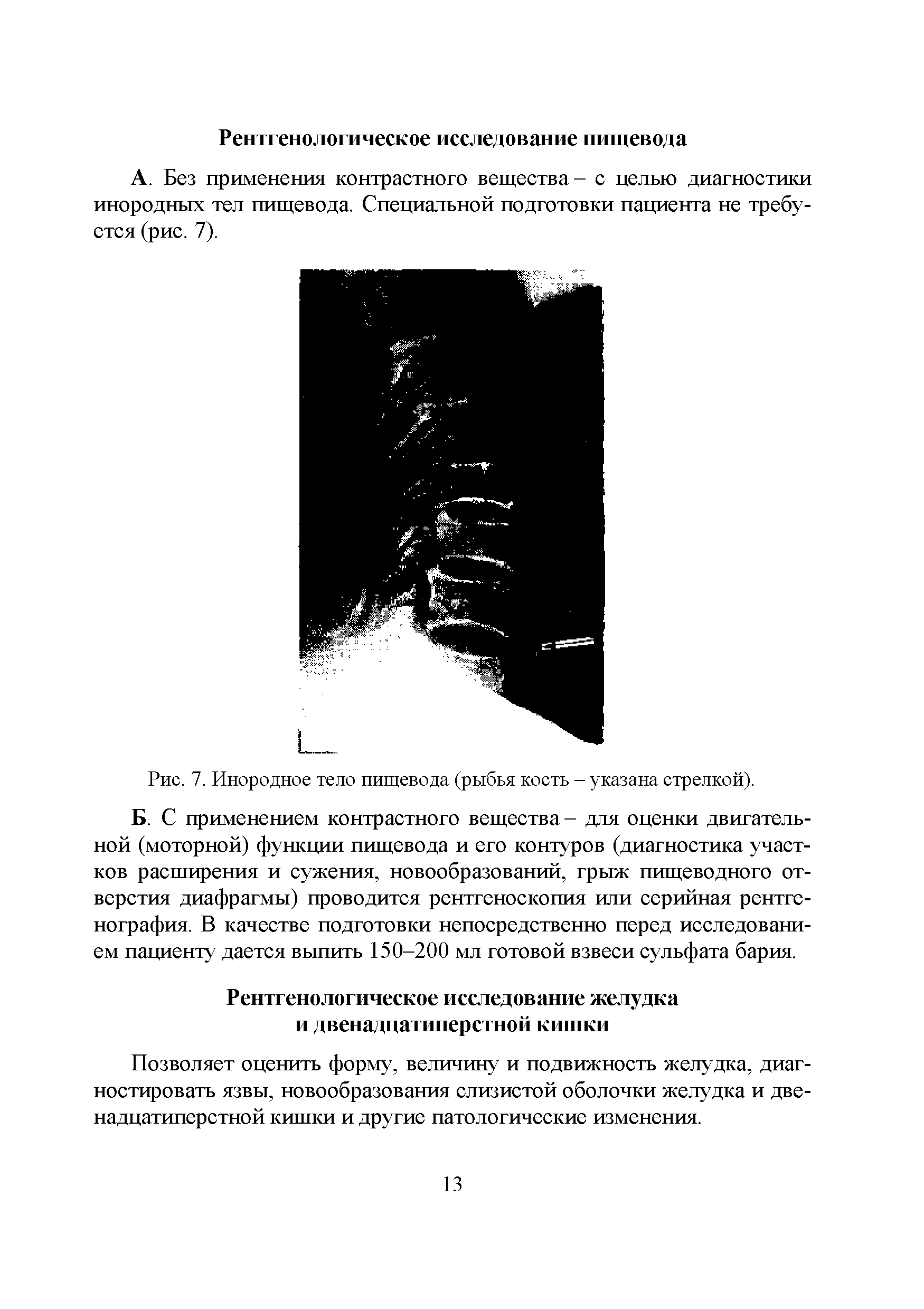 Рис. 7. Инородное тело пищевода (рыбья кость - указана стрелкой).