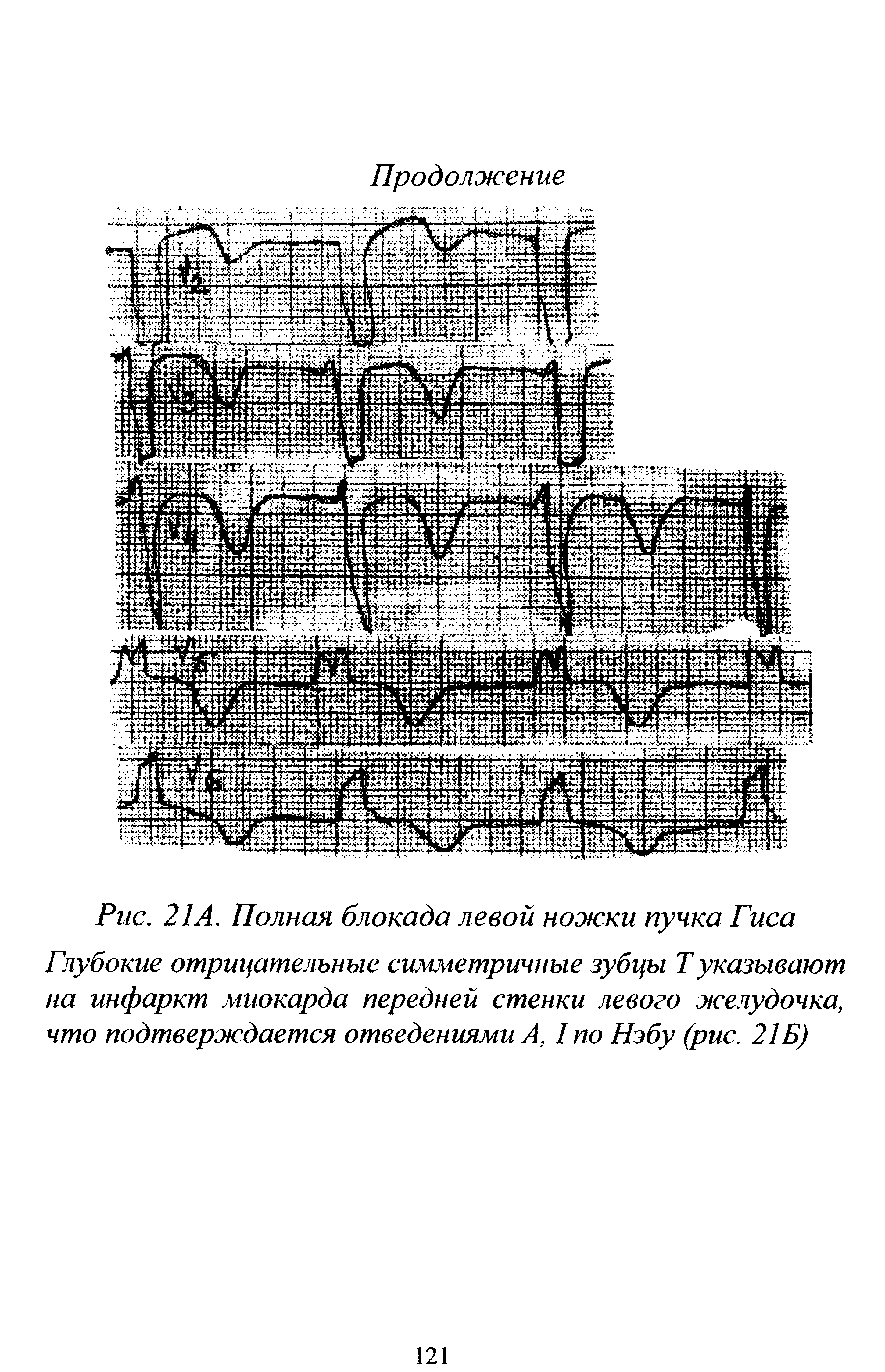 Рис. 21 А. Полная блокада левой ножки пучка Гиса Глубокие отрицательные симметричные зубцы Туказывают на инфаркт миокарда передней стенки левого желудочка, что подтверждается отведениями А, I Нэбу (рис. 21 Б)...
