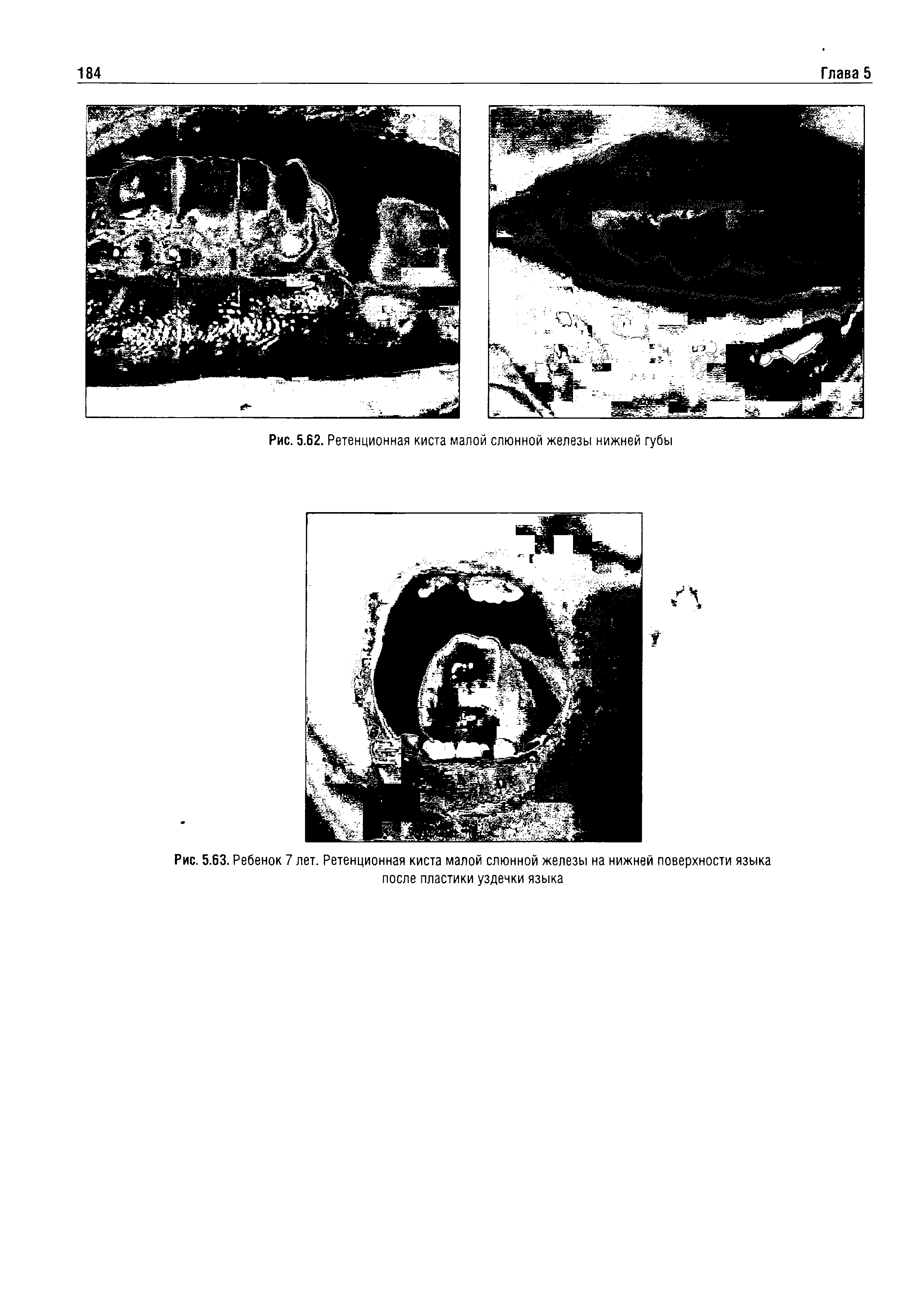 Рис. 5.63. Ребенок 7 лет. Ретенционная киста малой слюнной железы на нижней поверхности языка после пластики уздечки языка...