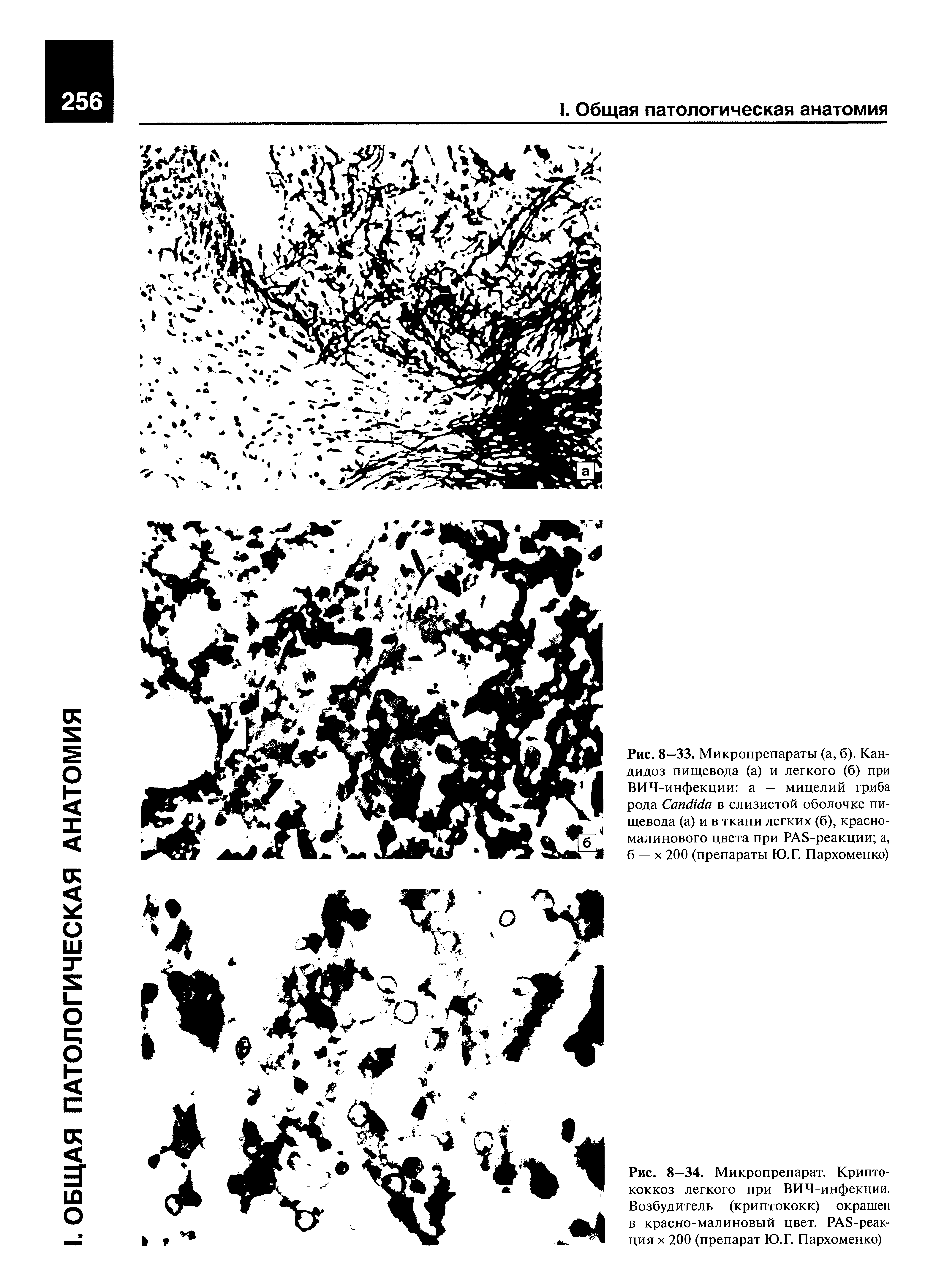 Рис. 8—33. Микропрепараты (а, б). Кандидоз пищевода (а) и легкого (б) при ВИЧ-инфекции а — мицелий гриба рода C в слизистой оболочке пищевода (а) и в ткани легких (б), красномалинового цвета при PAS-реакции а, б — х 200 (препараты Ю.Г. Пархоменко)...