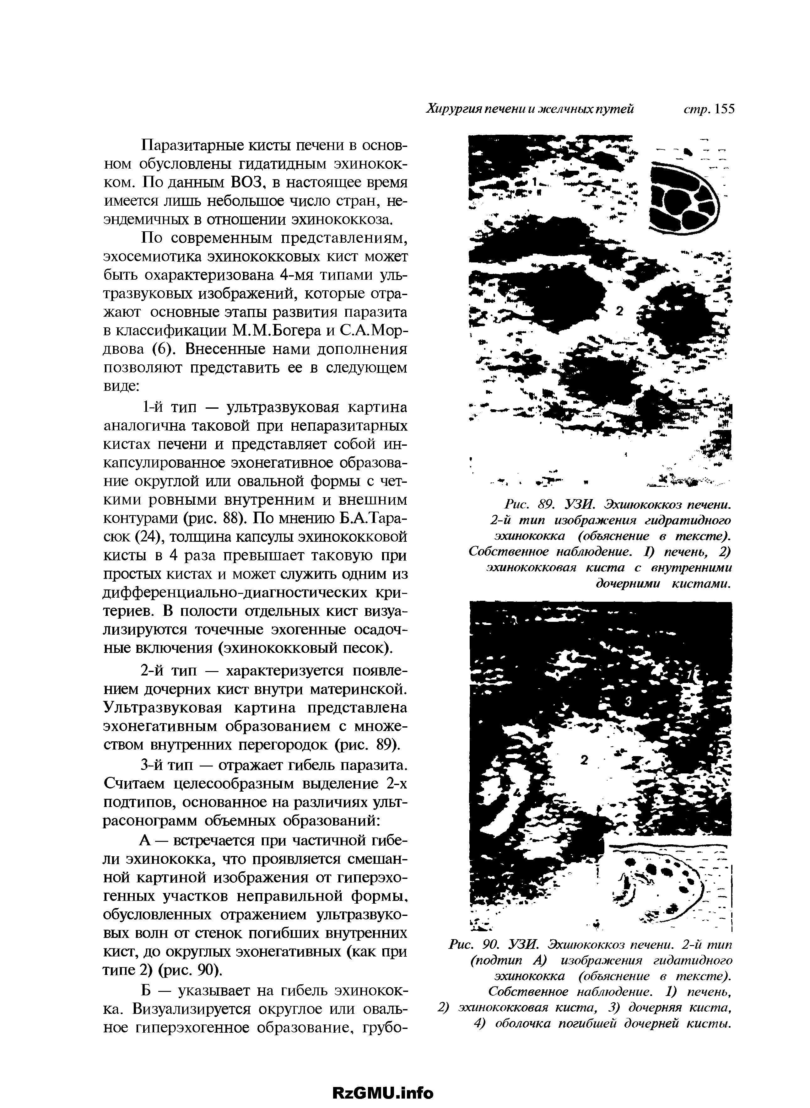 Рис. 90. УЗИ. Эхинококкоз печени. 2-й тип (подтип А) изображения гидатидного эхинококка (объяснение в тексте). Собственное наблюдение. 1) печень, 2) эхинококковая киста, 3) дочерняя киста, 4) оболочка погибшей дочерней кисты.