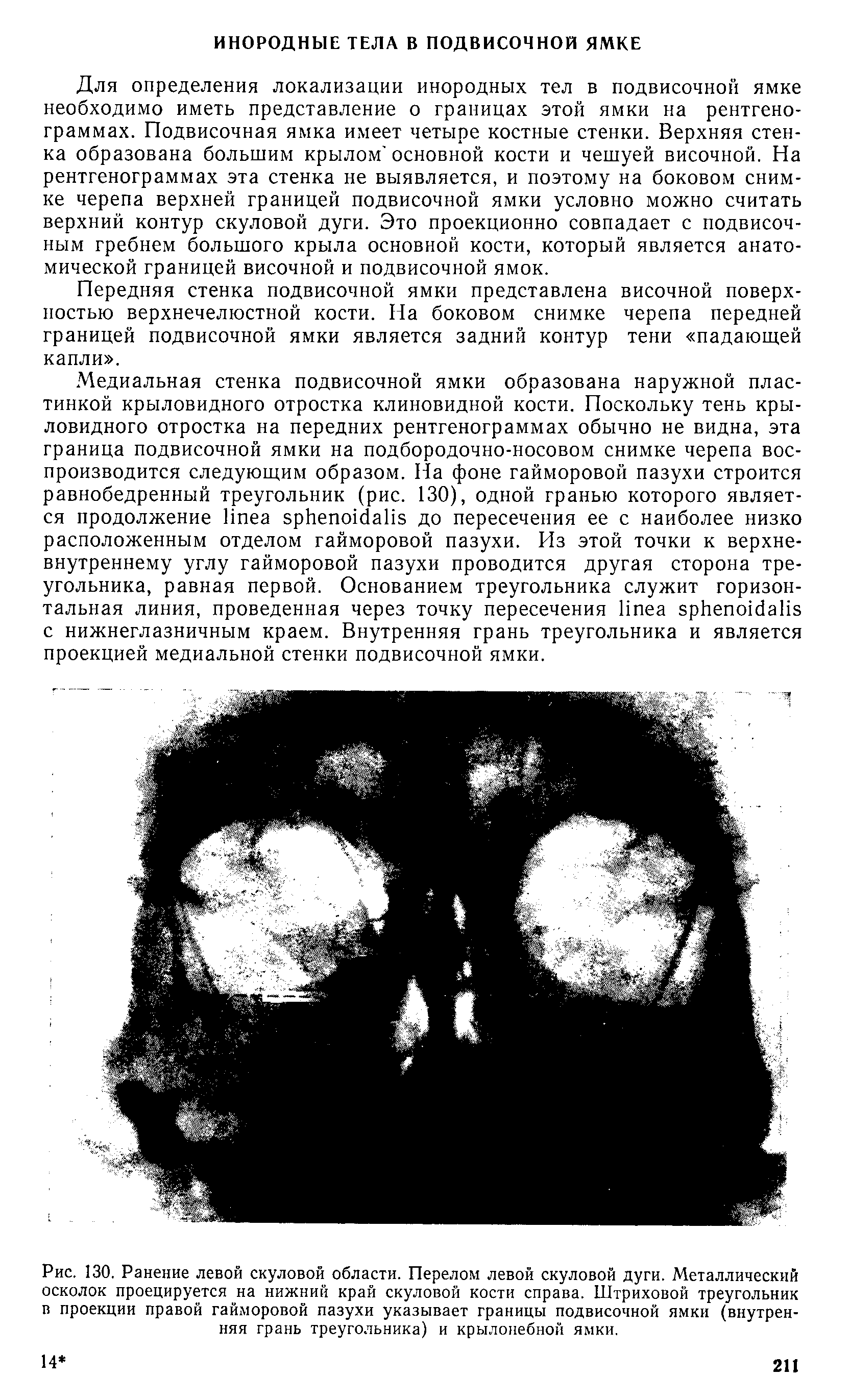 Рис. 130. Ранение левой скуловой области. Перелом левой скуловой дуги. Металлический осколок проецируется на нижний край скуловой кости справа. Штриховой треугольник в проекции правой гайморовой пазухи указывает границы подвисочной ямки (внутренняя грань треугольника) и крылонебной ямки.