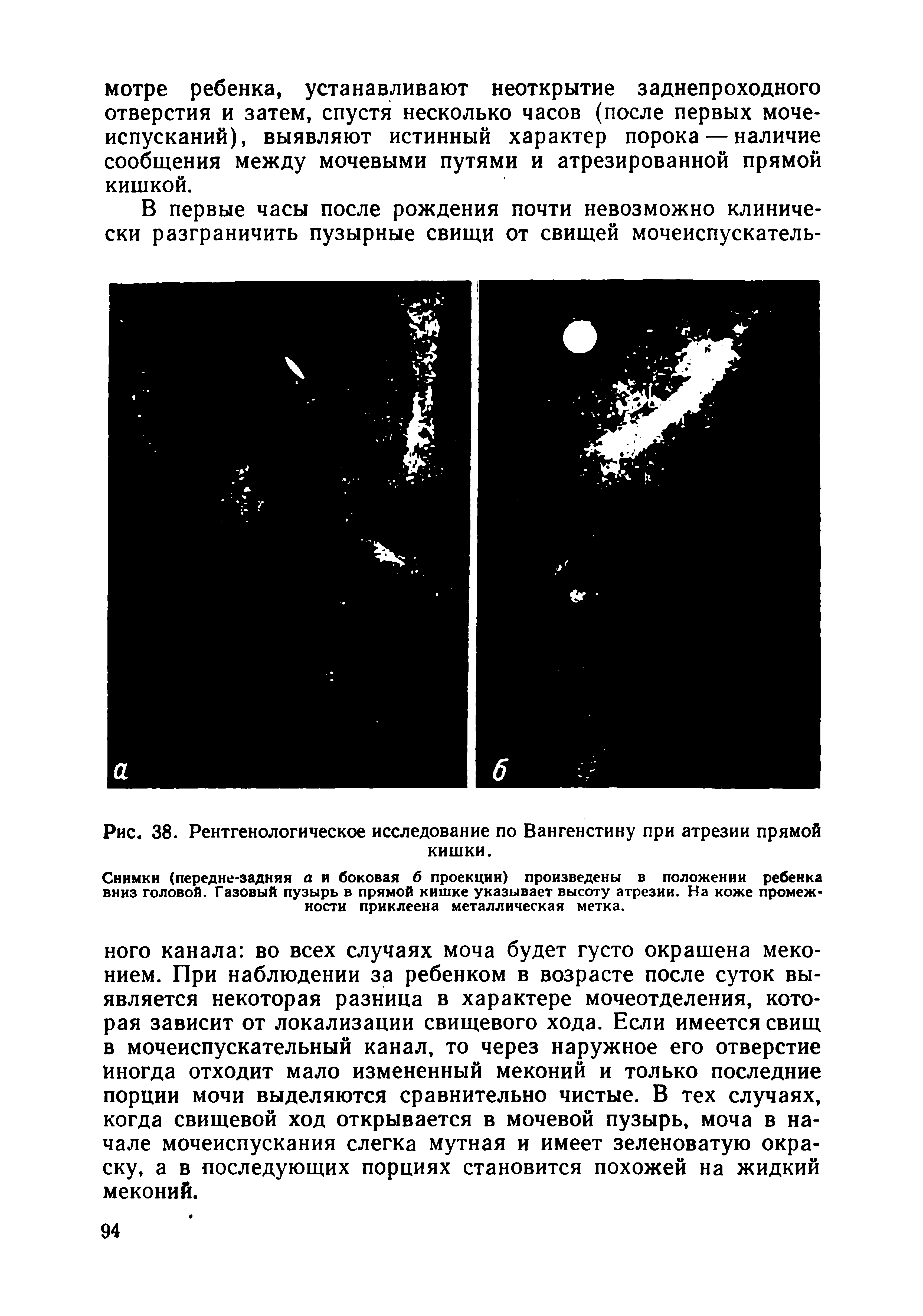 Рис. 38. Рентгенологическое исследование по Вангенстину при атрезии прямой кишки.