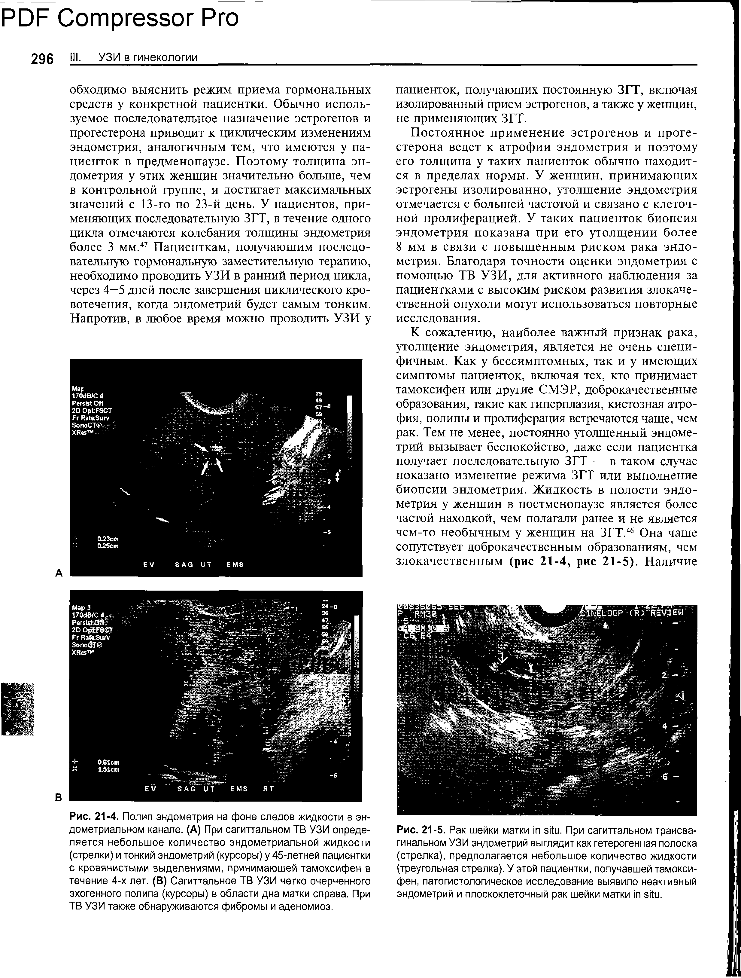 Рис. 21-5. Рак шейки матки . При сагиттальном трансвагинальном УЗИ эндометрий выглядит как гетерогенная полоска (стрелка), предполагается небольшое количество жидкости (треугольная стрелка). У этой пациентки, получавшей тамоксифен, патогистологическое исследование выявило неактивный эндометрий и плоскоклеточный рак шейки матки .