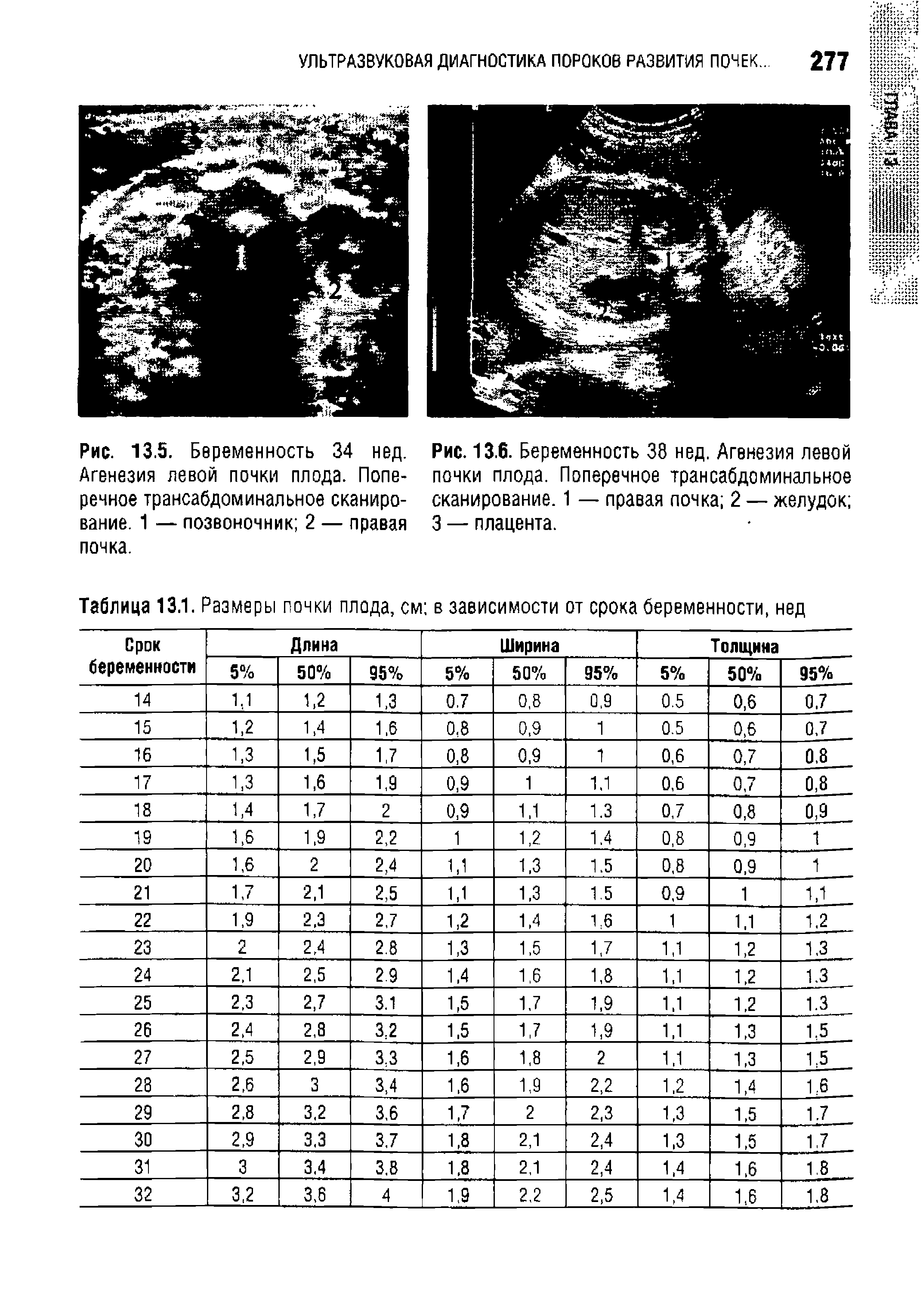 Рис. 13.6. Беременность 38 нед. Агенезия левой почки плода. Поперечное трансабдоминальное сканирование. 1 — правая почка 2 — желудок 3 — плацента.