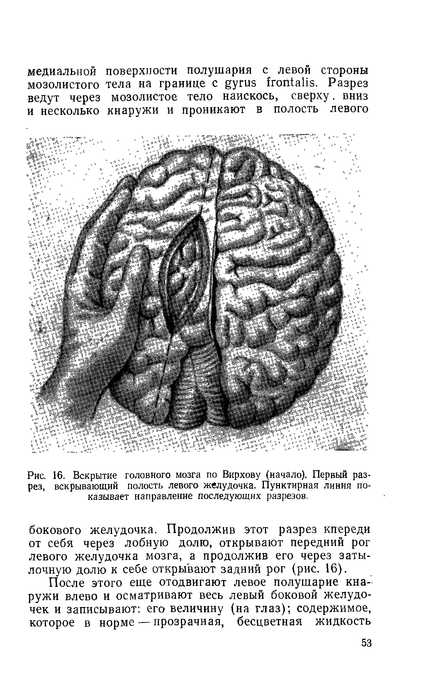 Рис. 16. Вскрытие головного мозга по Вирхову (начало). Первый разрез, вскрывающий полость левого желудочка. Пунктирная линия показывает направление последующих разрезов.