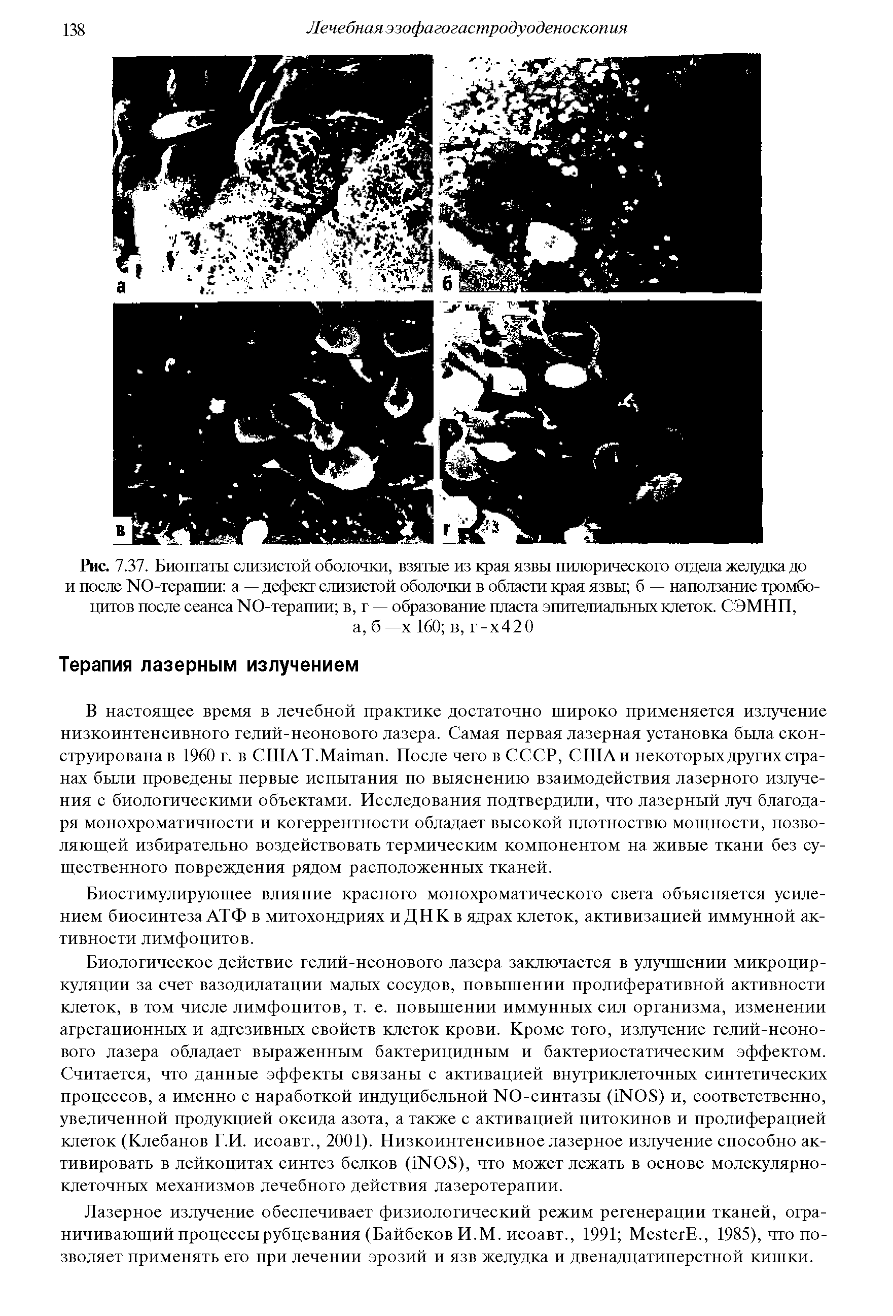 Рис. 7.37. Биоптаты слизистой оболочки, взятые из края язвы пилорического отдела желудка до и после 18Ю-терапии а — дефект слизистой оболочки в области края язвы б — наползание тромбоцитов после сеанса >Ю-терапии в, г — образование пласта эпителиальных клеток. СЭМНП, а, б —х 160 в, г-х420...