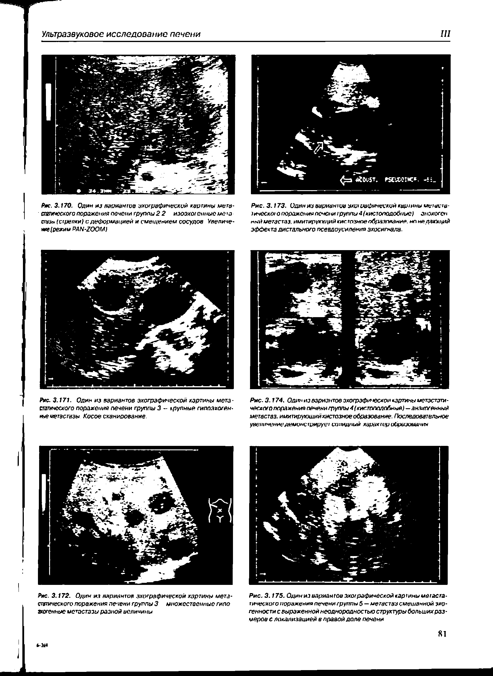 Рис. 3.173. Один из вариантов зхиюнфическийкар/нны метнете-тическот о поражении печени группы (кистонодобтнжц анэхоген ный мегастаз, имитируккцийкистпзноеобцэзпмние. нпнндзедркй эффекта дистального псевдоусиления эхосигнала.