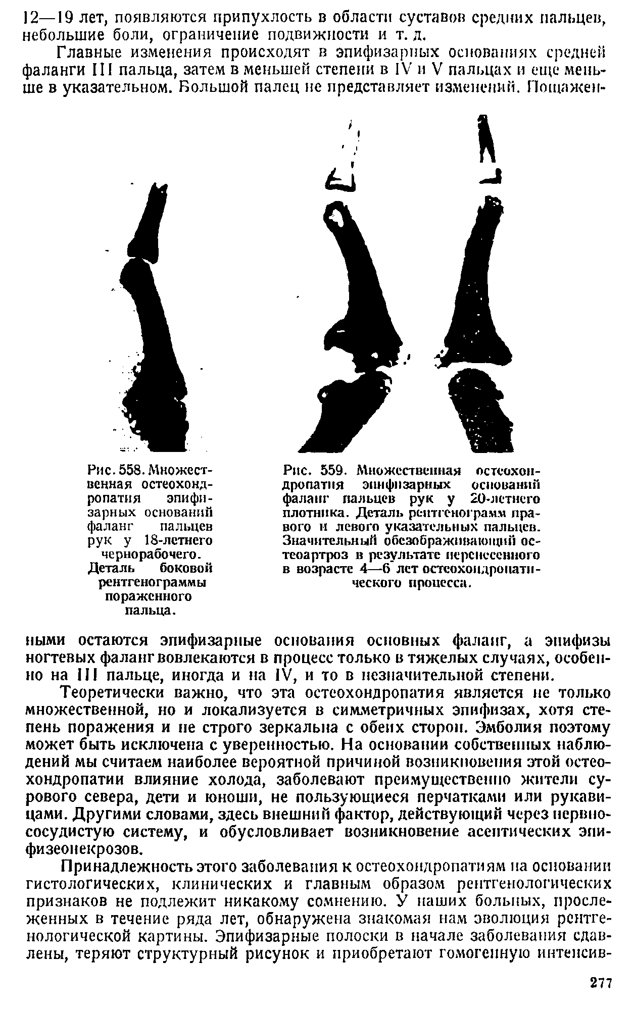 Рис. 559. Множественная остеохондропатия эпифизарных оснований фаланг пальцев рук у 20-летнего плотника. Деталь рентгенограмм правого и левого указательных пальцев. Значительный обезображивающий остеоартроз в результате перенесенного в возрасте 4—6 лет остсохоидропати-ческого процесса.