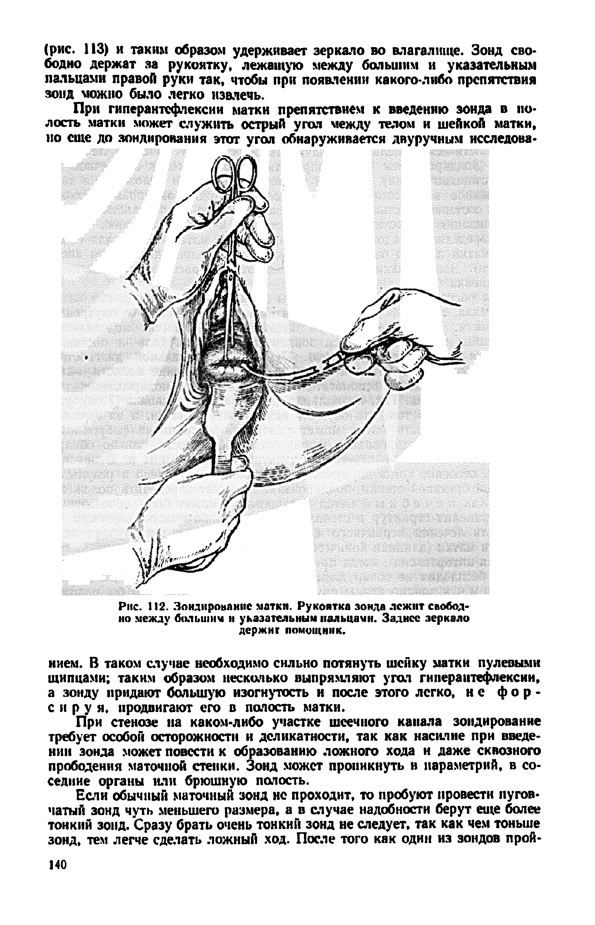 Рис. 112. Зондирование матки. Рукоятка зонда лежит свободно между большим и указательным пальцами. Заднее зеркало держит помощник.