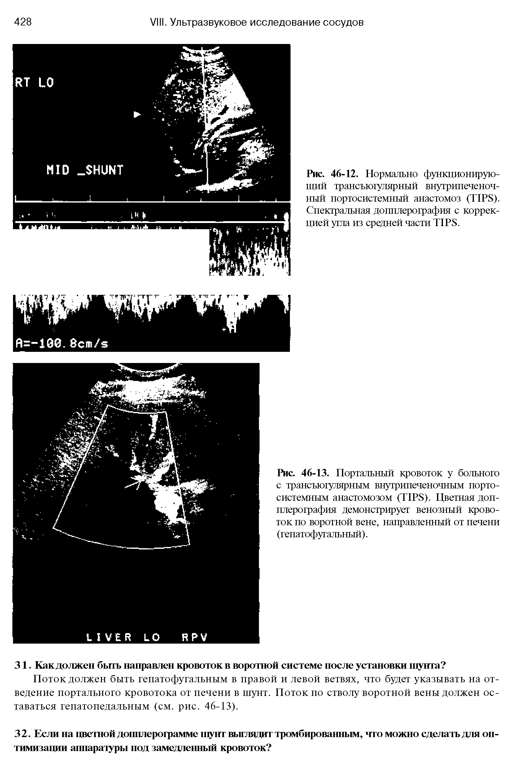 Рис. 46-13. Портальный кровоток у больного с трансъюгулярным внутрипеченочным порто-системным анастомозом (TIPS). Цветная допплерография демонстрирует венозный кровоток по воротной вене, направленный от печени (гепатофугальный).