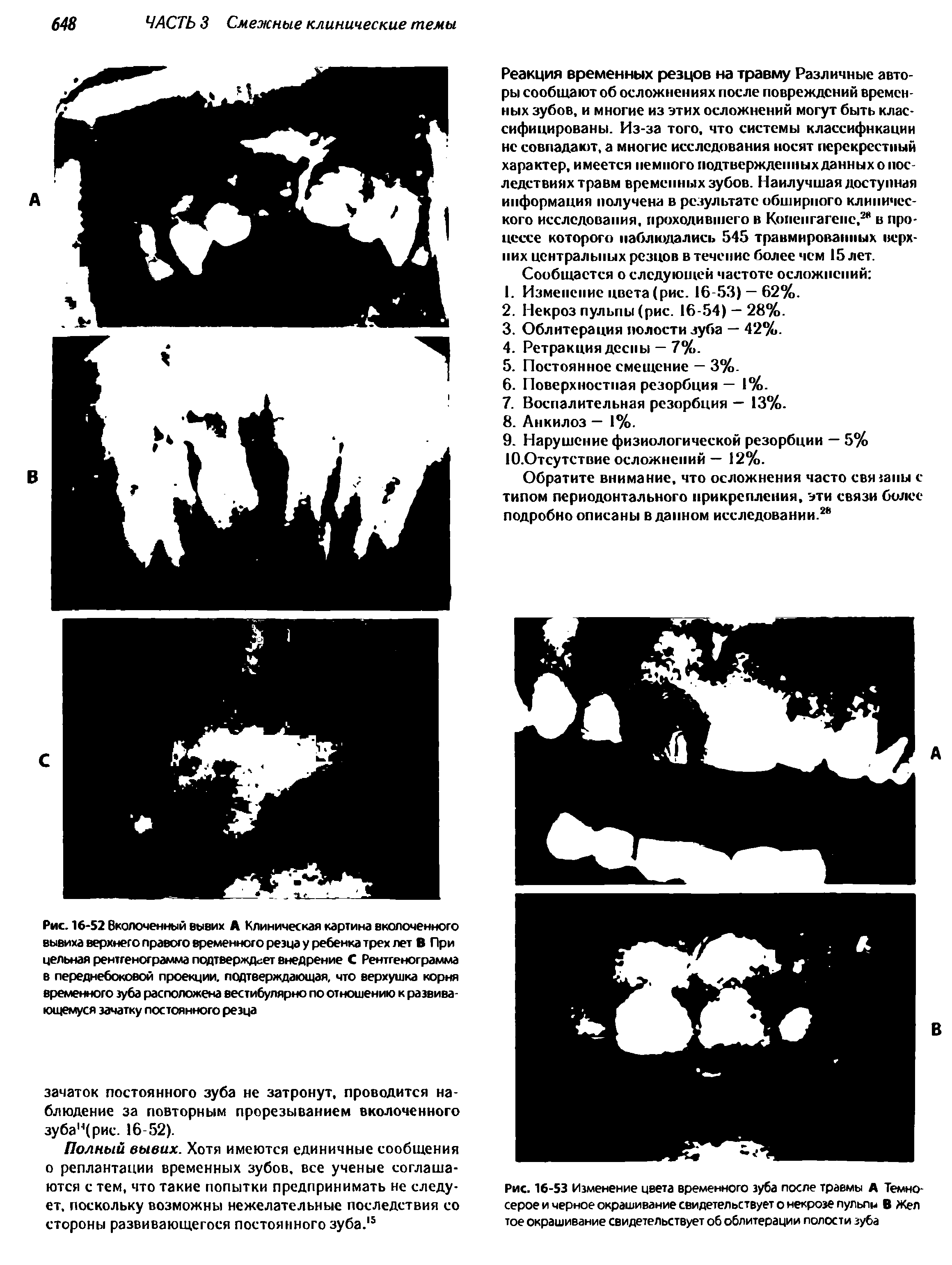 Рис. 16-53 Изменение цвета временного зуба после травмы А Темносерое и черное окрашивание свидетельствует о некрозе пульпы В Жел тое окрашивание свидетельствует об облитерации полости зуба...