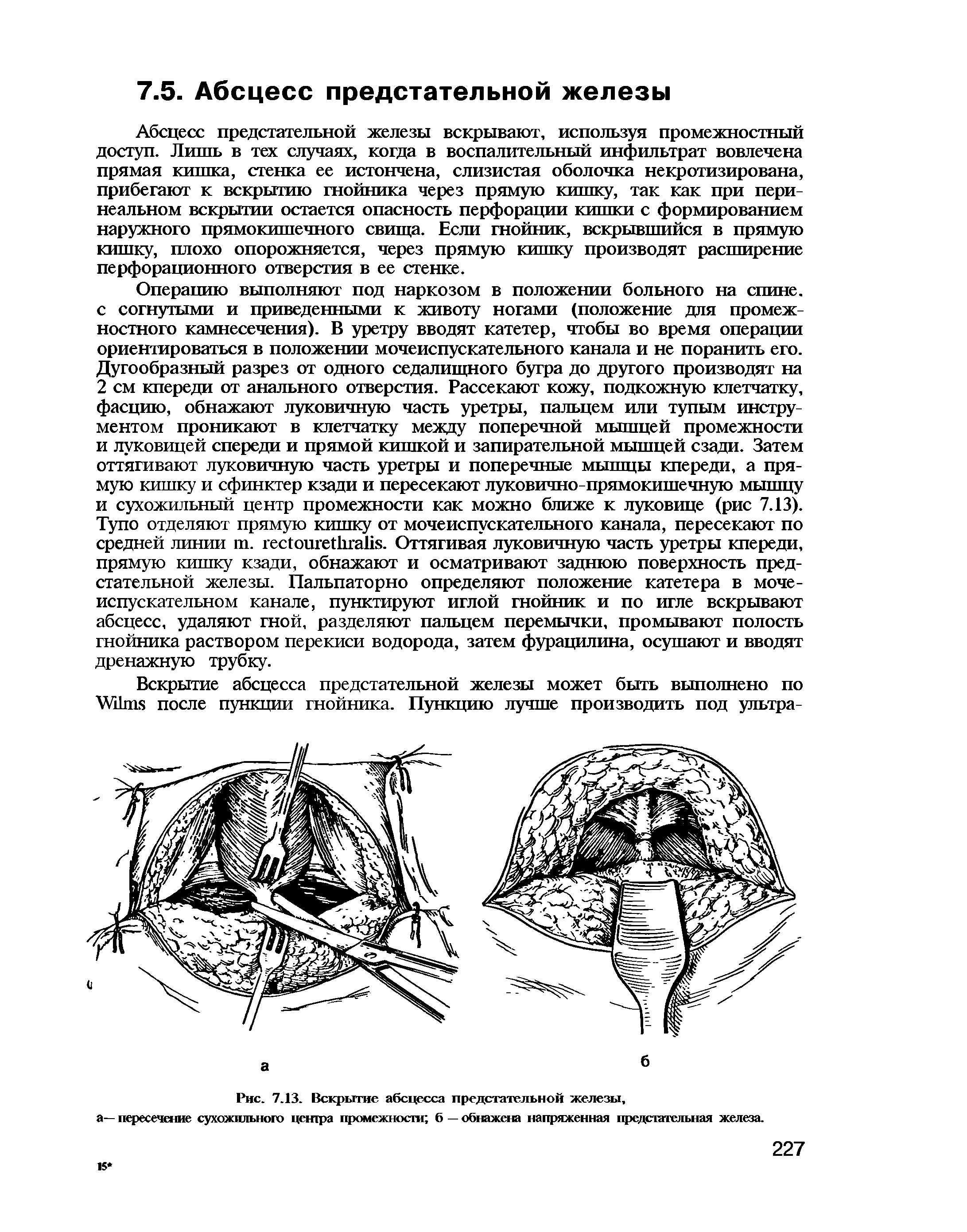 Рис. 7.13. Вскрытие абсцесса предстательной железы, а— пересечение сухожильного центра промежности б — обнажена напряженная предстательная железа.