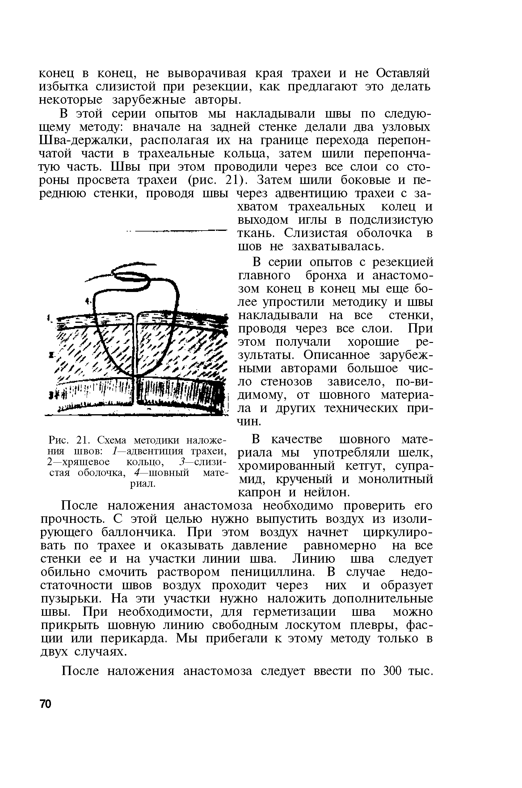 Рис. 21. Схема методики наложения швов / адвентиция трахеи, 2—хрящевое кольцо, 5—слизистая оболочка, 4 шовный материал.