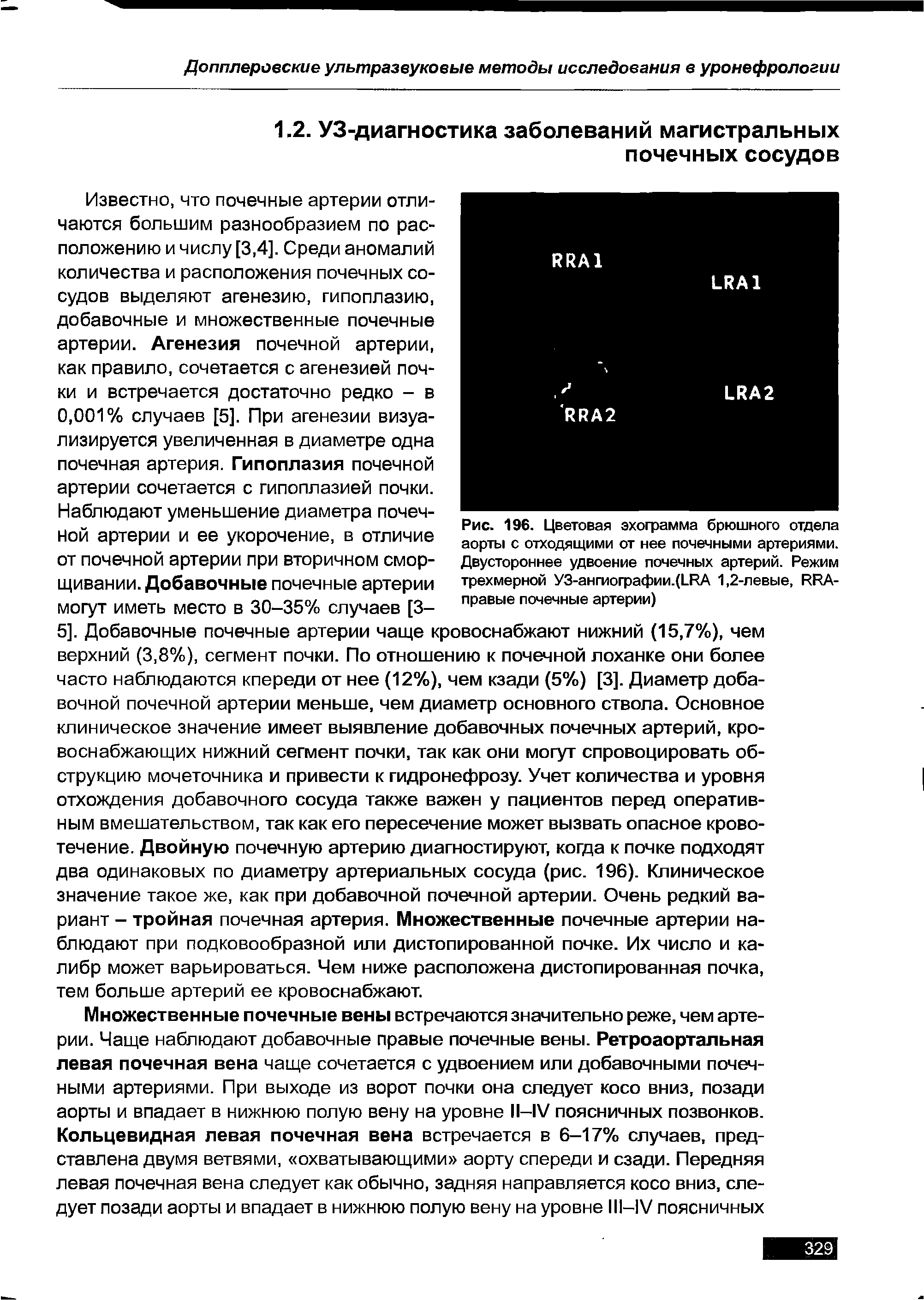 Рис. 196. Цветовая эхограмма брюшного отдела аорты с отходящими от нее почечными артериями. Двустороннее удвоение почечных артерий. Режим трехмерной УЗ-ангиографии-фИА 1,2-левые, РИА-правые почечные артерии)...