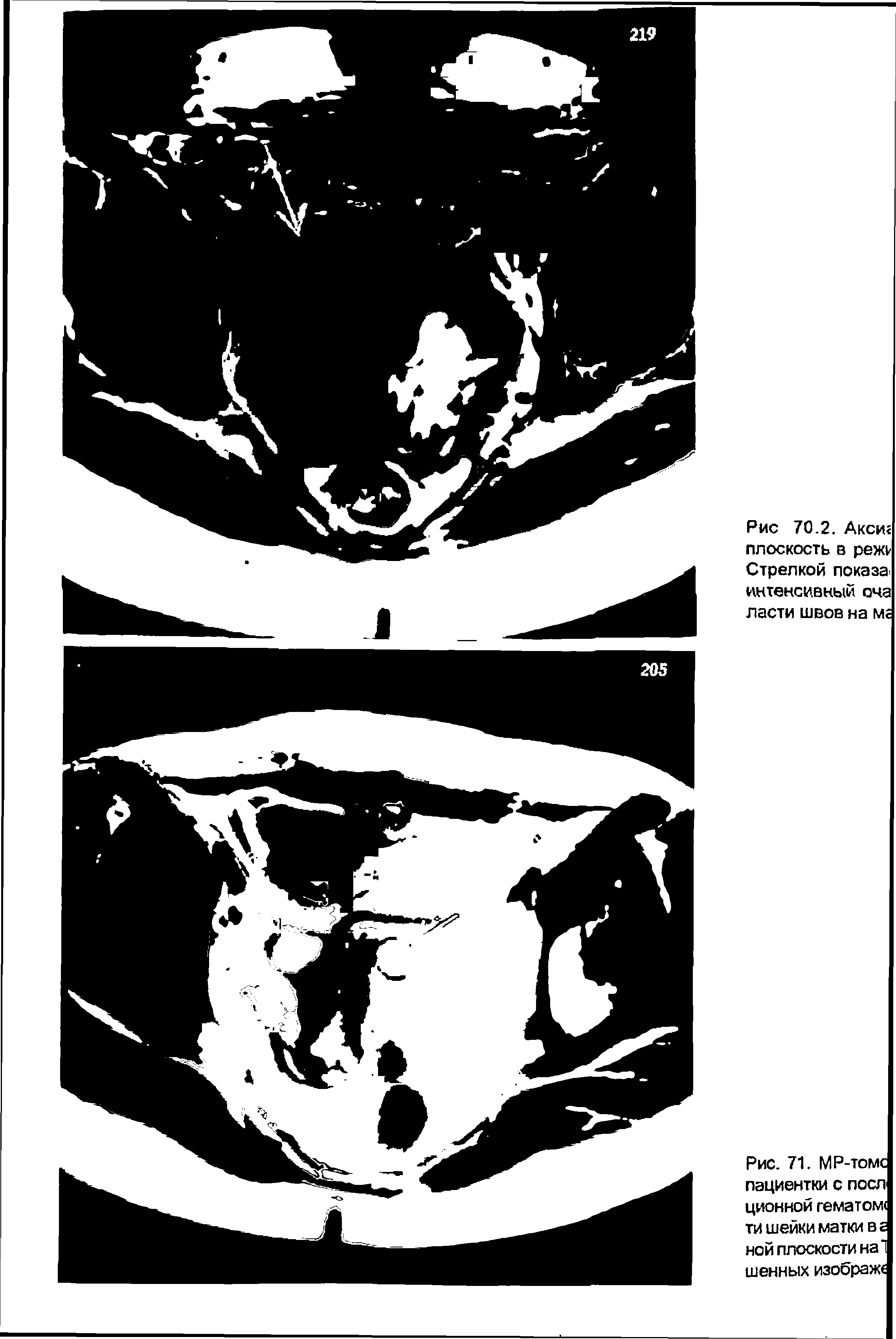 Рис. 71. МР-томс пациентки с поел ционной гематом ти шейки матки в а ной плоскости на шенных изображу...