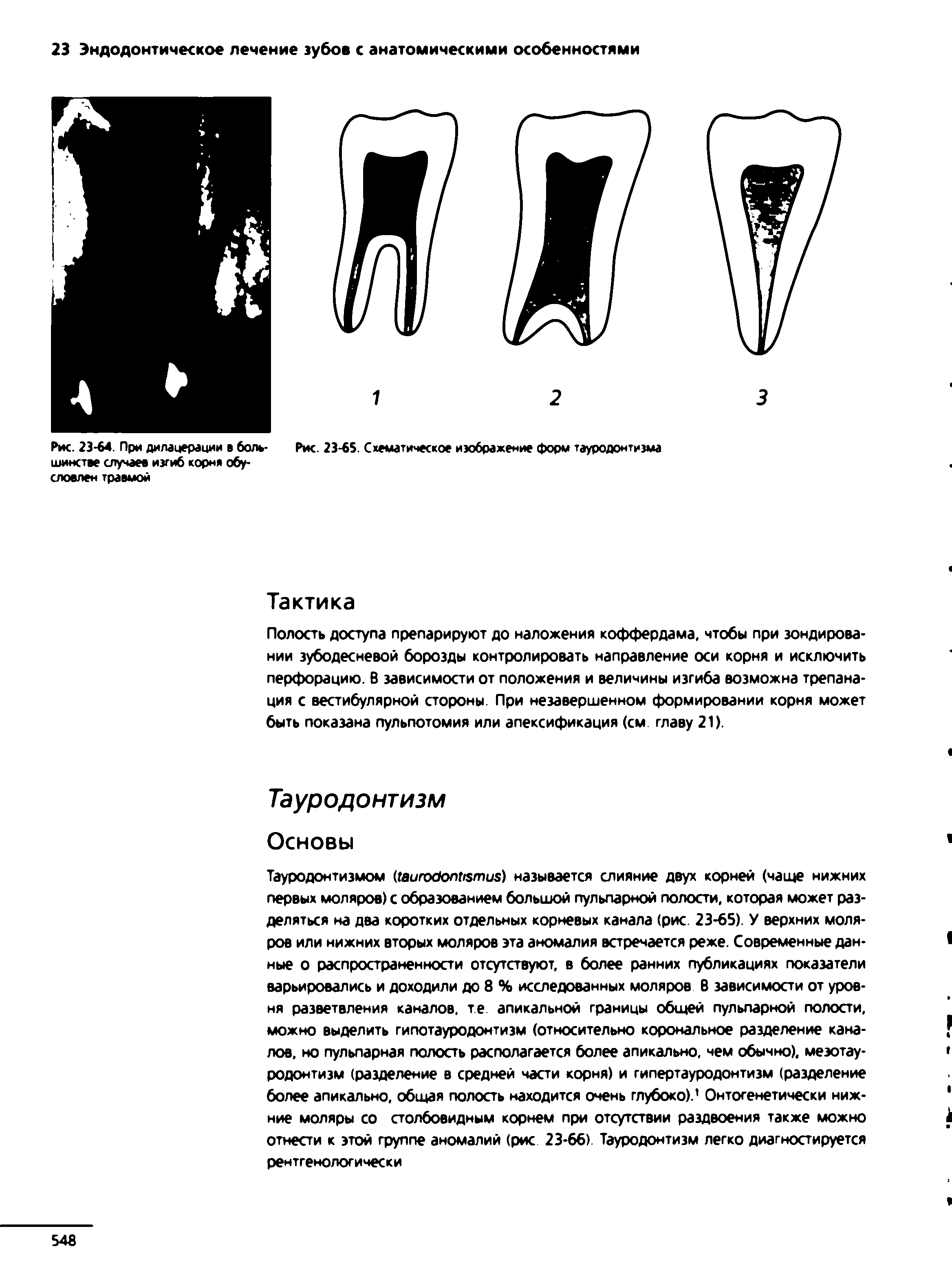 Рис. 23-64 При дилацерации в боль- Рис. 23-65. Схематическое изображение форм тауродонтизма шинсгве случаев изгиб корня обу-...