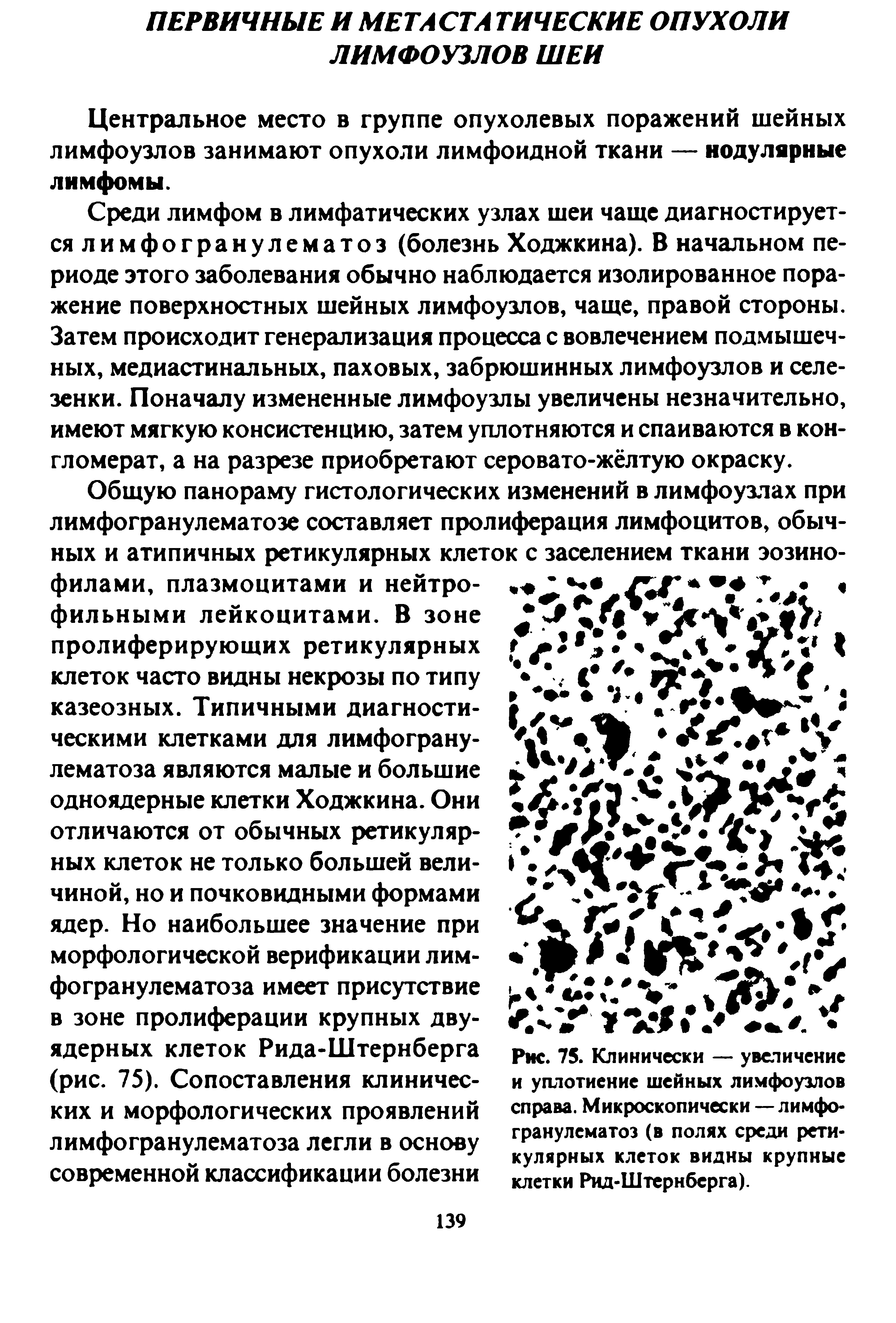 Рис. 75. Клинически — увеличение и уплотнение шейных лимфоузлов справа. Микроскопически — лимфогранулематоз (в полях среди ретикулярных клеток видны крупные клетки Рид-Штернберга).