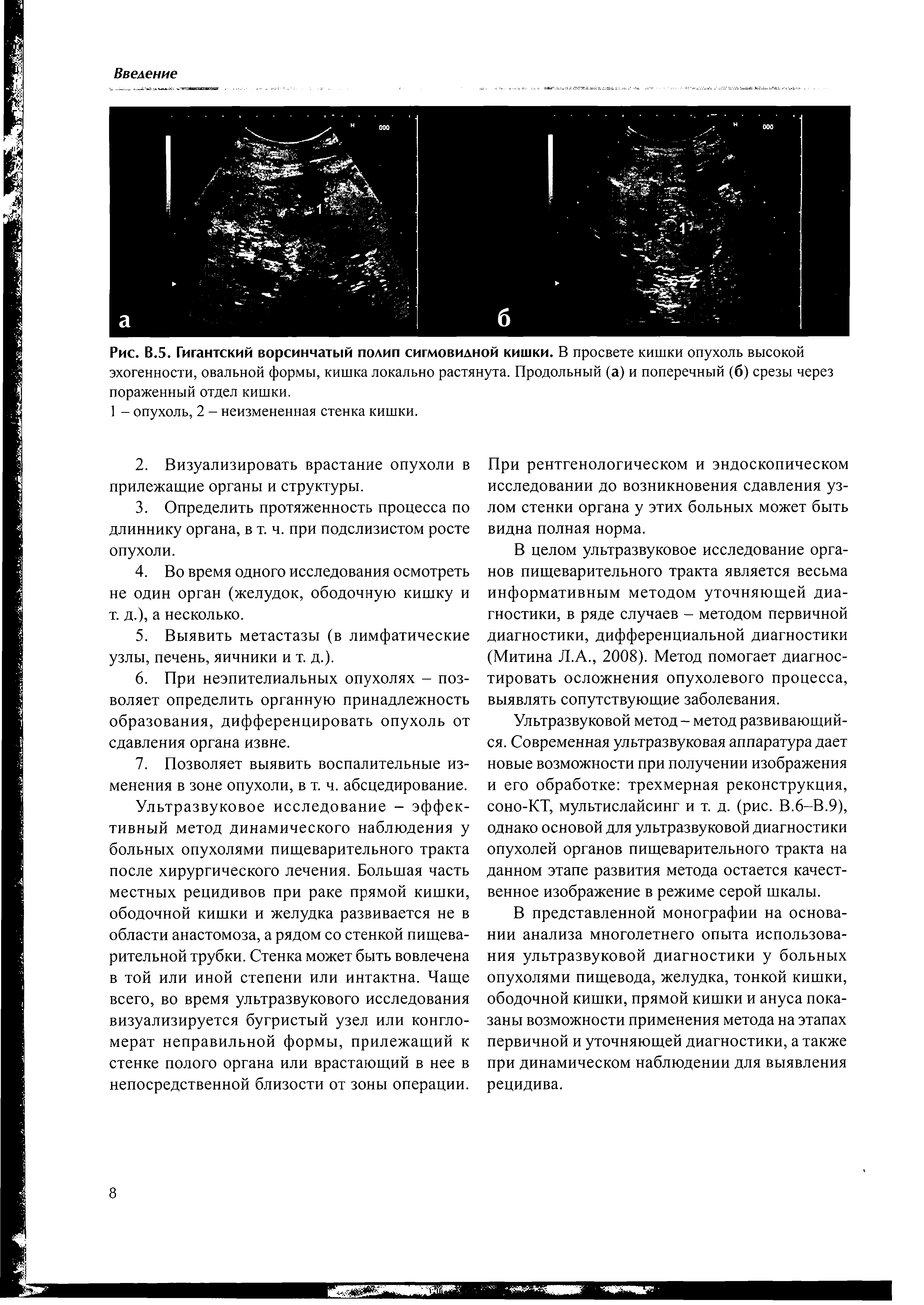 Рис. В.5. Гигантский ворсинчатый полип сигмовидной кишки. В просвете кишки опухоль высокой эхогенности, овальной формы, кишка локально растянута. Продольный (а) и поперечный (б) срезы через пораженный отдел кишки.