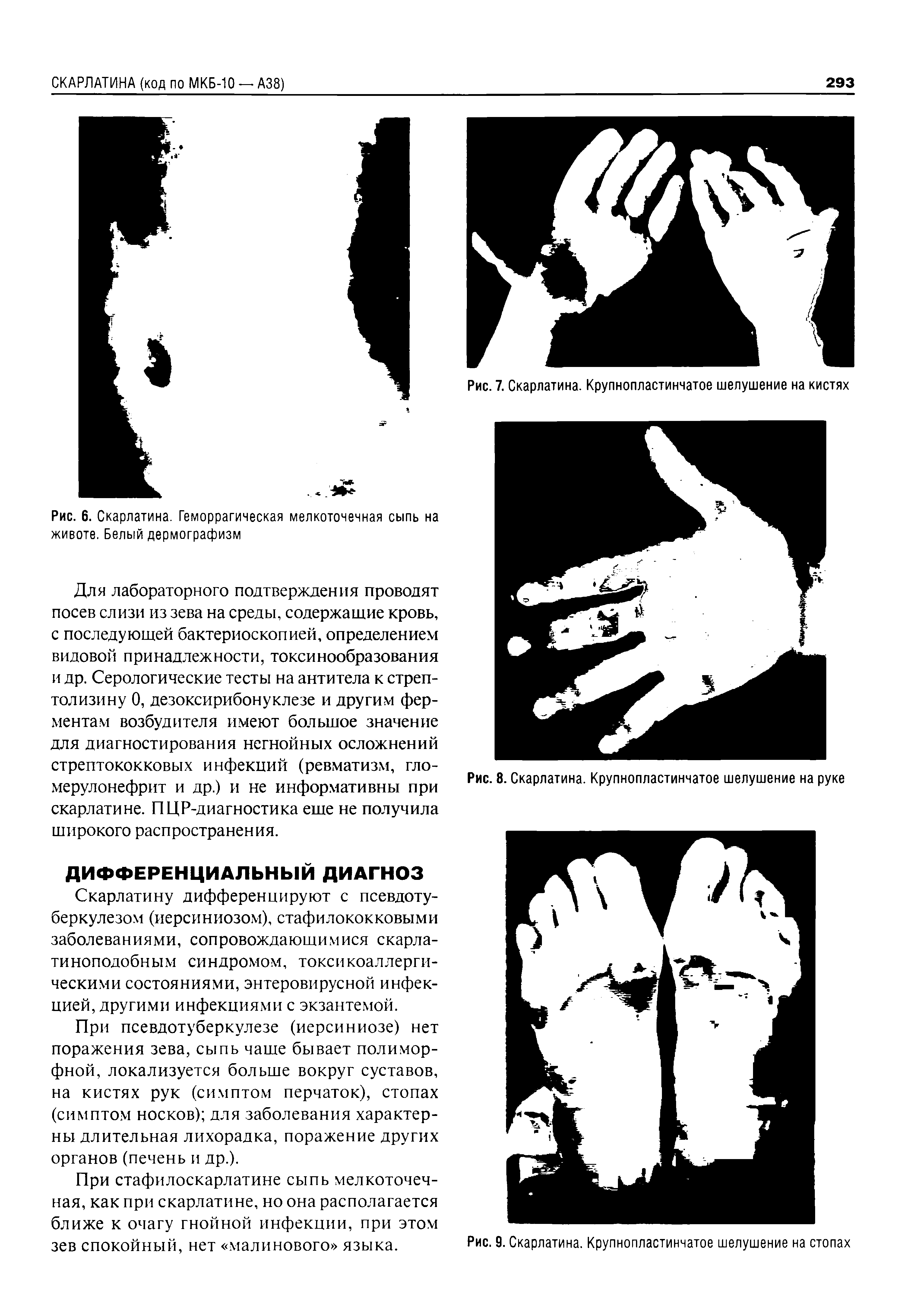 Рис. 6. Скарлатина. Геморрагическая мелкоточечная сыпь на животе. Белый дермографизм...