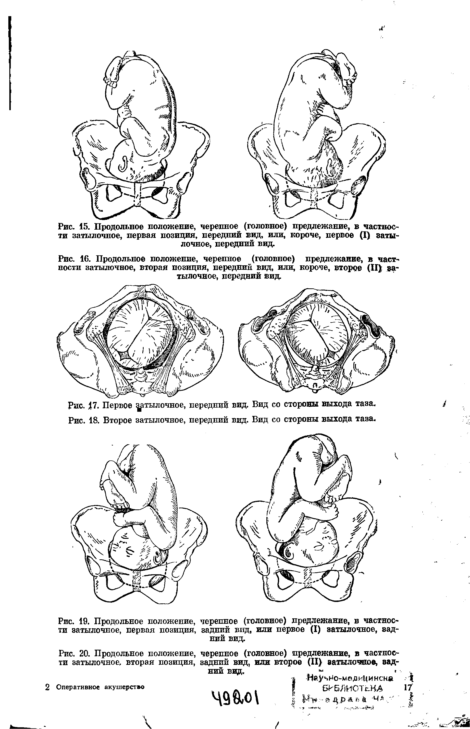 Рис. 16. Продольное положение, черепное (головное) предлежание, в частности затылочное, вторая позиция, передний вид, или, короче, второе (II) затылочное, передний вид.
