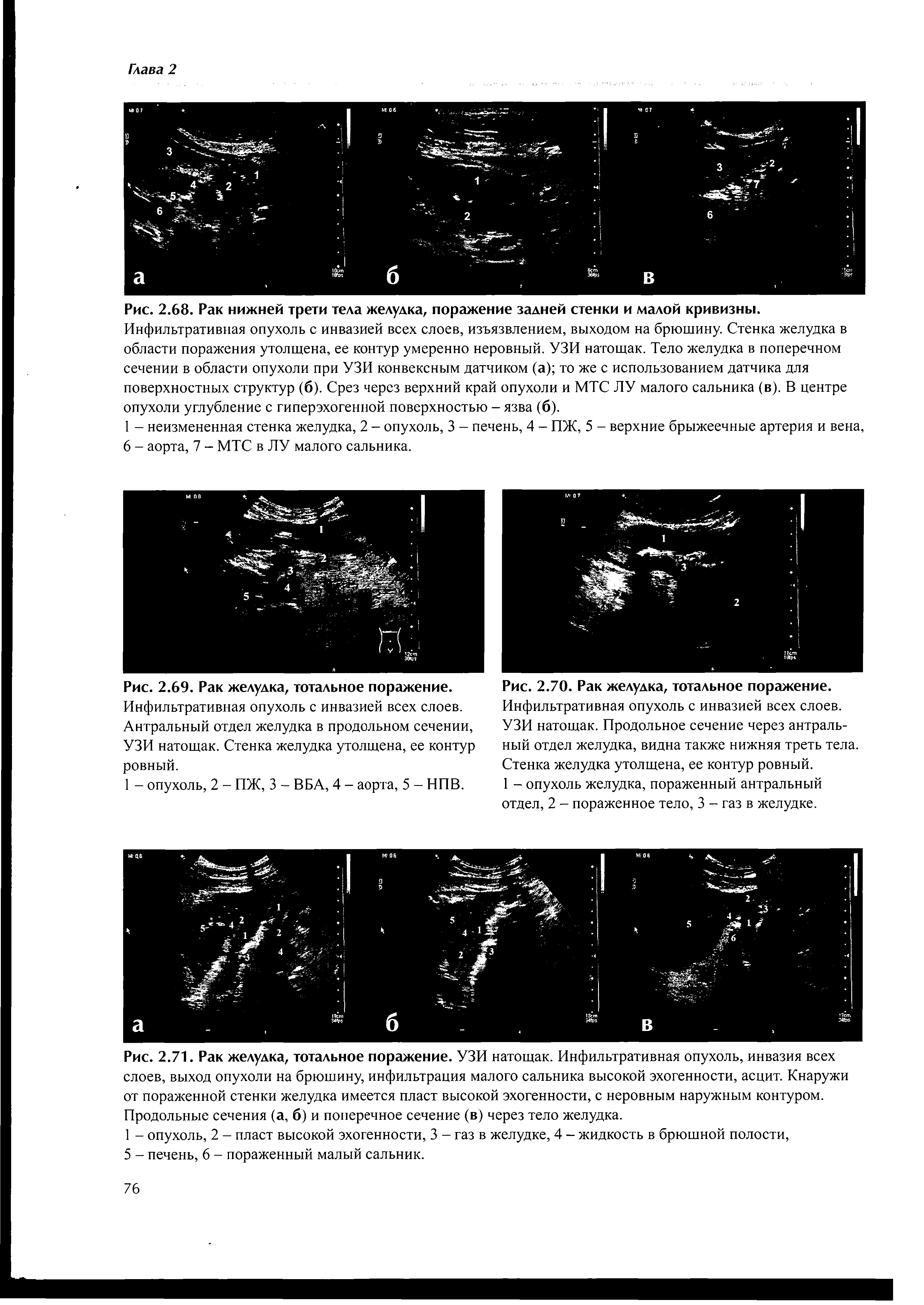 Рис. 2.71. Рак желудка, тотальное поражение. УЗИ натощак. Инфильтративная опухоль, инвазия всех слоев, выход опухоли на брюшину, инфильтрация малого сальника высокой эхогенности, асцит. Кнаружи от пораженной стенки желудка имеется пласт высокой эхогенности, с неровным наружным контуром. Продольные сечения (а, б) и поперечное сечение (в) через тело желудка.