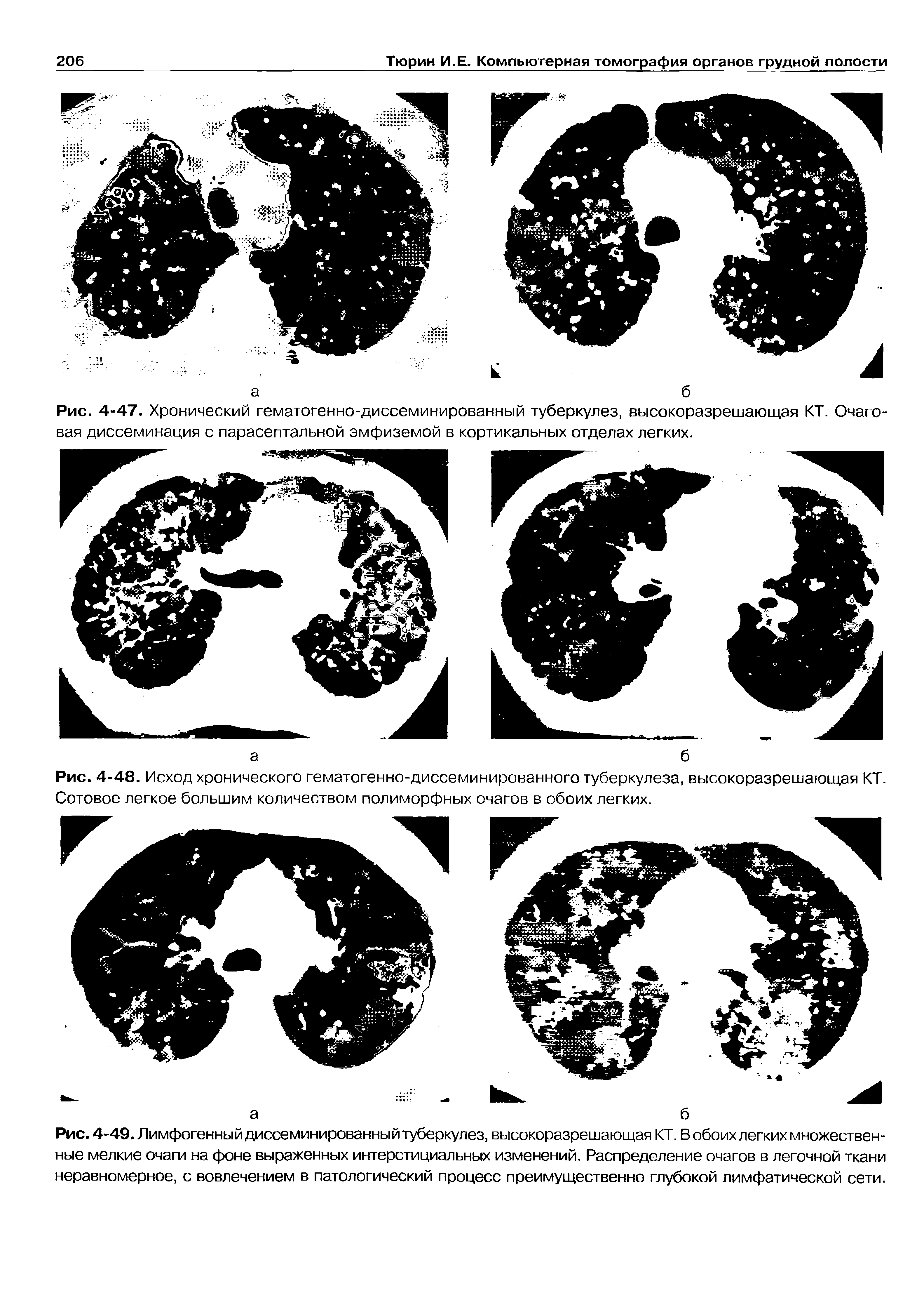 Рис. 4-49. Лимфогенный диссеминированный туберкулез, высокоразрешающая КТ. В обоих легких множественные мелкие очаги на фоне выраженных интерстициальных изменений. Распределение очагов в легочной ткани неравномерное, с вовлечением в патологический процесс преимущественно глубокой лимфатической сети.