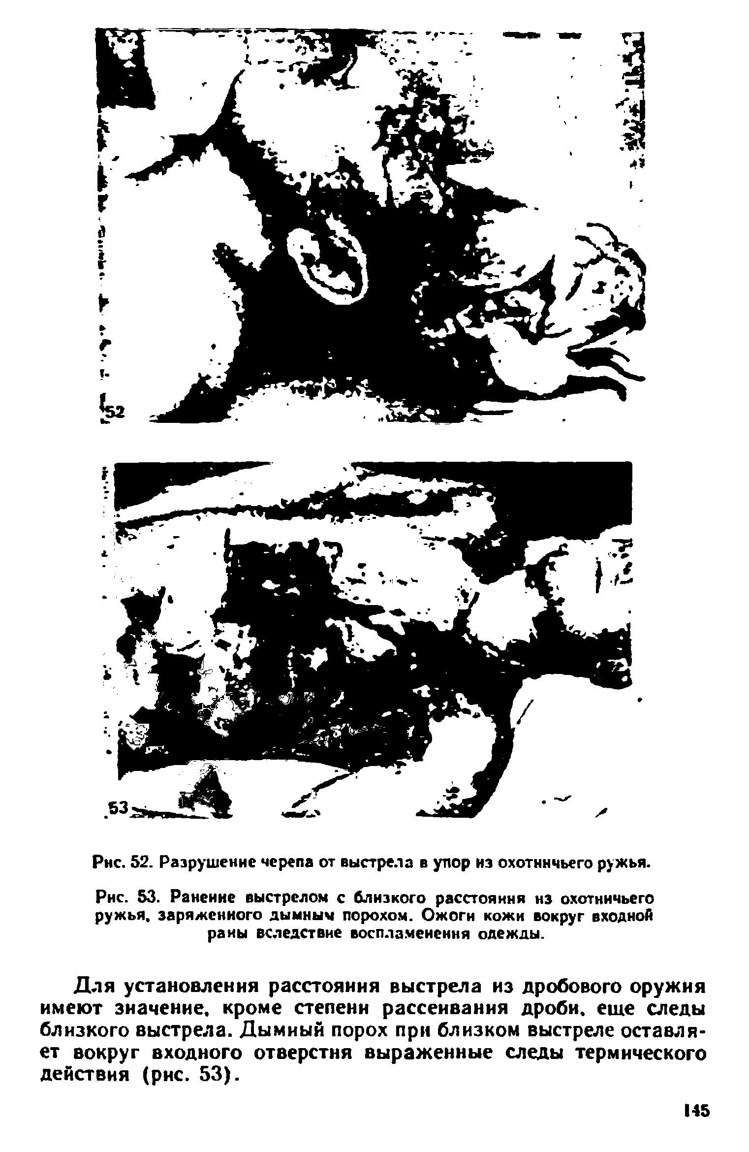 Рис. 53. Ранение выстрелом с близкого расстояния нз охотничьего ружья, заряженного дымным порохом. Ожоги кожи вокруг входной раны вследствие воспламеиення одежды.