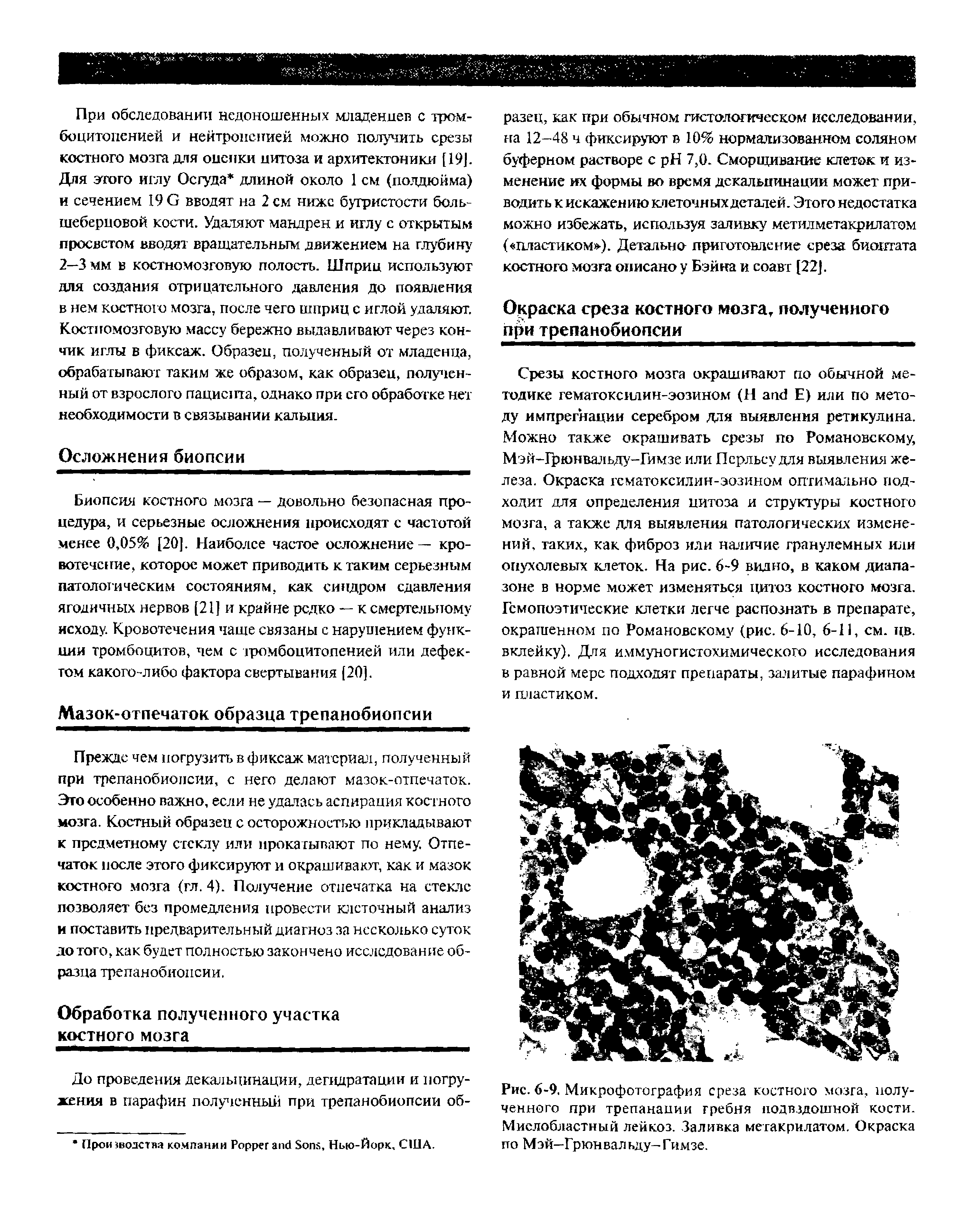 Рис. 6-9. Микрофотография среза костного мозга, полученного при трепанации гребня подвздошной кости. Мисл области ый лейкоз. Заливка метакрилатом. Окраска по Мэй-Грюнвальду-Гимзе.