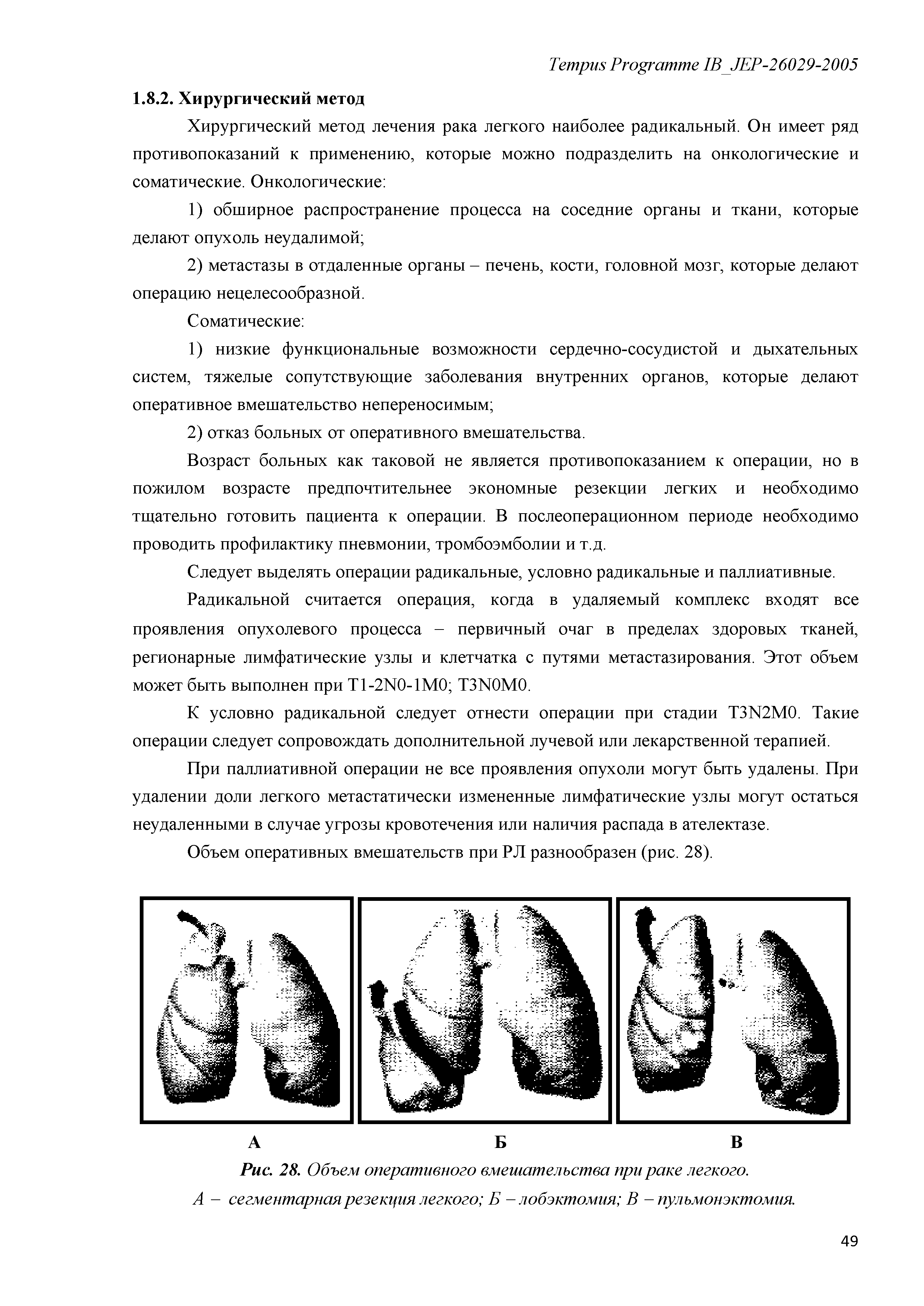 Рис. 28. Объем оперативного вмешательства при раке легкого. А - сегментарная резекция легкого Б - лобэктомия В - пулъмонэктомия.