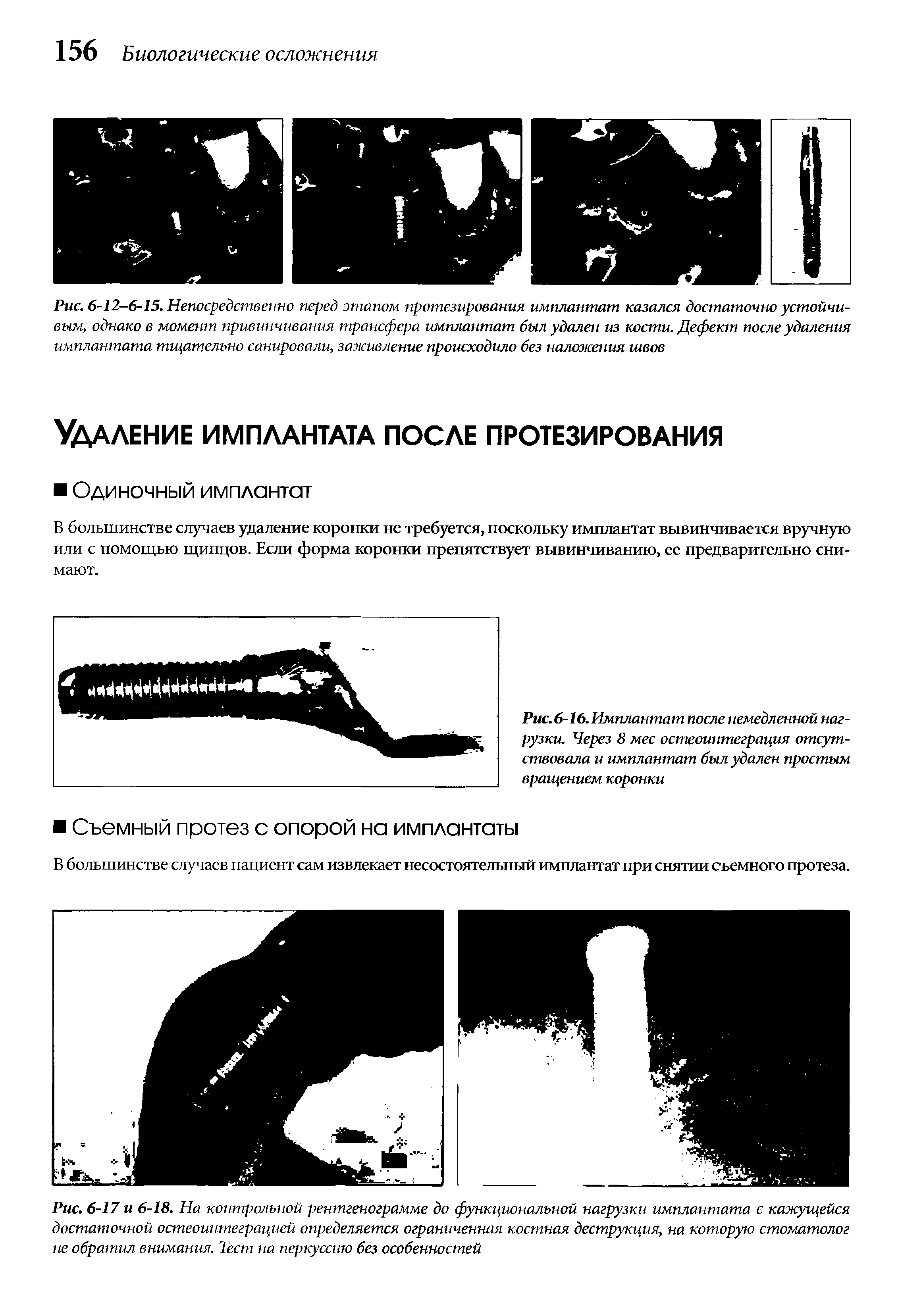 Рис. 6-16. Имплантат после немедленной нагрузки. Через 8 мес остеоинтеграция отсутствовала и имплантат был удален простым вращением коронки...