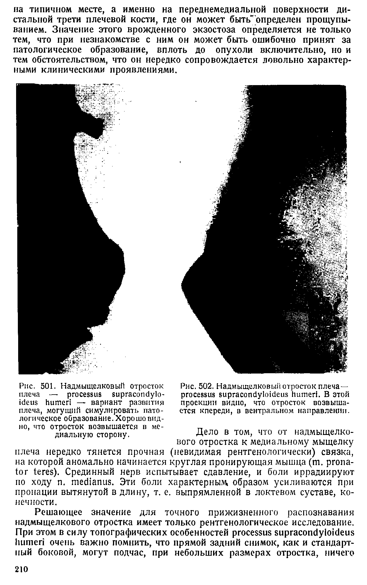 Рис. 501. Надмыщелковый отросток плеча — — вариант развития плеча, могущий симулировать патологическое образование. Хорошо видно, что отросток возвышается в медиальную сторону.