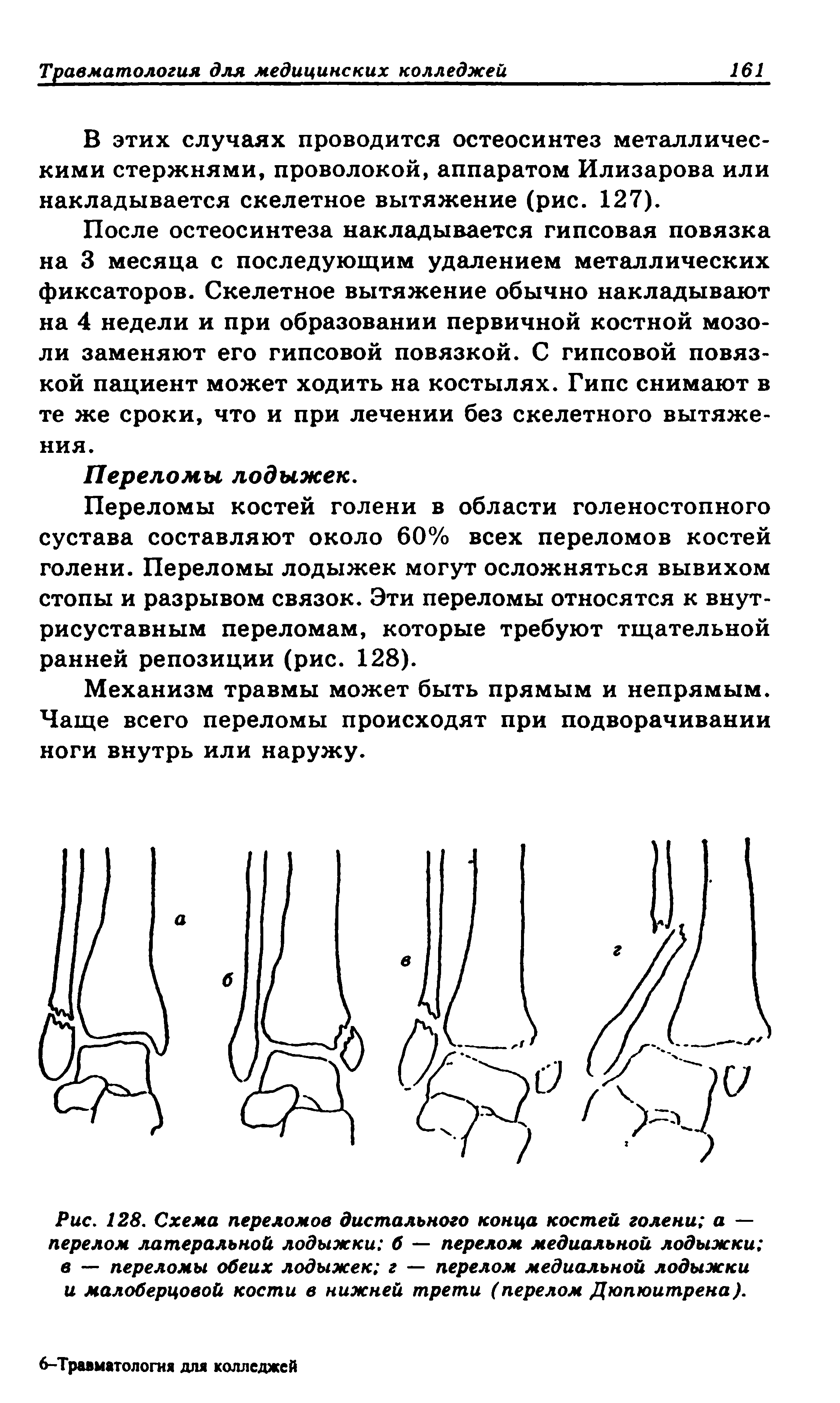 Рис. 128. Схема переломов дистального конца костей голени а — перелом латеральной лодыжки б — перелом медиальной лодыжки в — переломы обеих лодыжек г — перелом медиальной лодыжки и малоберцовой кости в нижней трети (перелом Дюпюитрена).