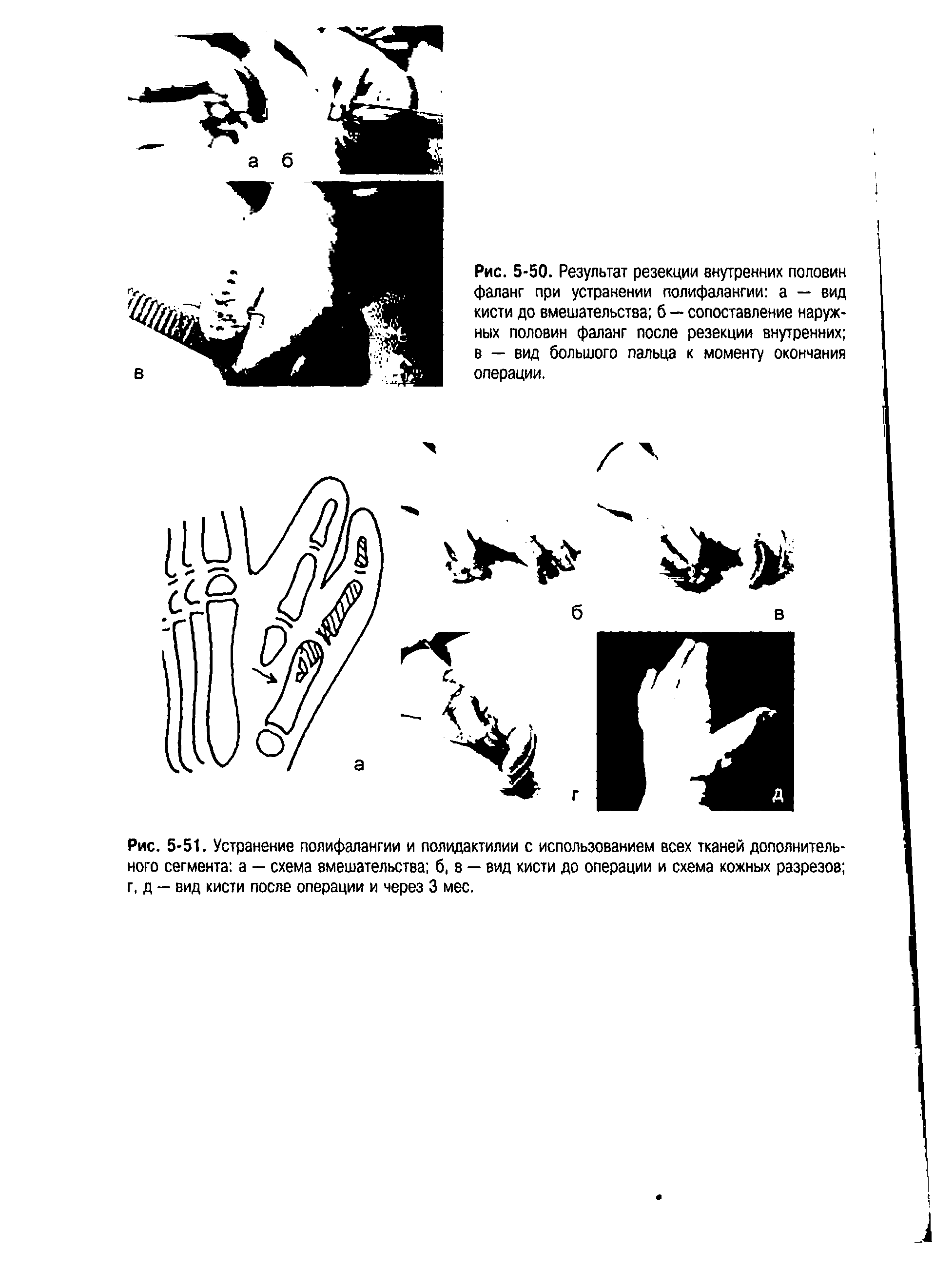 Рис. 5-51. Устранение полифалангии и полидактилии с использованием всех тканей дополнительного сегмента а — схема вмешательства б, в — вид кисти до операции и схема кожных разрезов г, д — вид кисти после операции и через 3 мес.