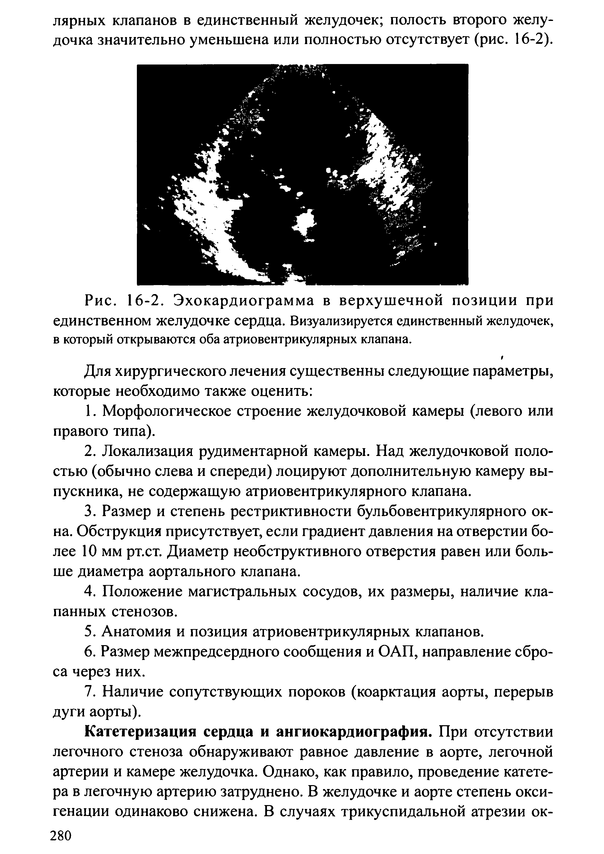 Рис. 16-2. Эхокардиограмма в верхушечной позиции при единственном желудочке сердца. Визуализируется единственный желудочек, в который открываются оба атриовентрикулярных клапана.