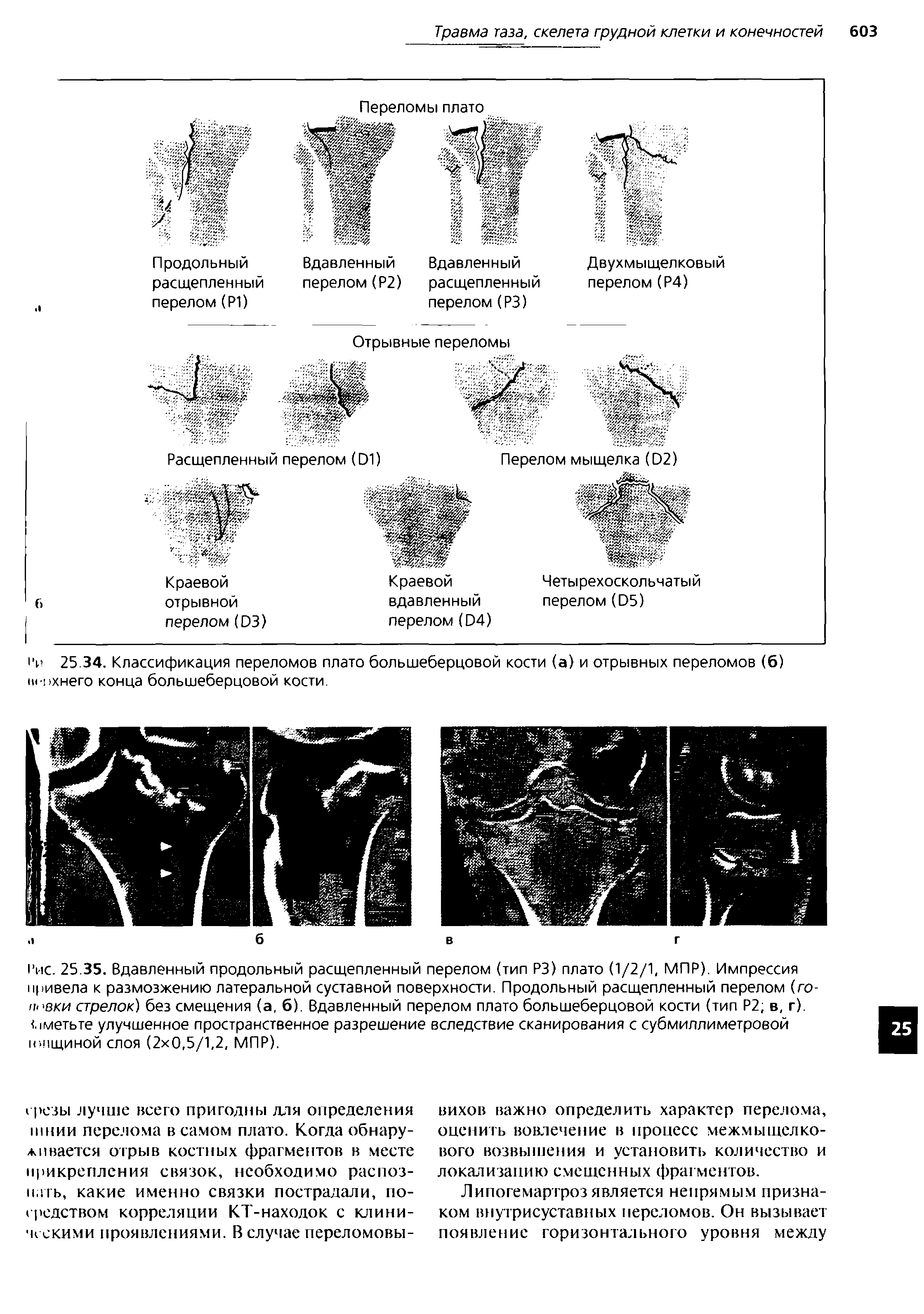 Рис. 25.35. Вдавленный продольный расщепленный перелом (тип РЗ) плато (1/2/1. МПР). Импрессия привела к размозжению латеральной суставной поверхности. Продольный расщепленный перелом (го-ппвки стрелок) без смещения (а, б). Вдавленный перелом плато большеберцовой кости (тип Р2, в. г). Заметьте улучшенное пространственное разрешение вследствие сканирования с субмиллиметровой н.цщиной слоя (2 0,5/1,2, МПР).