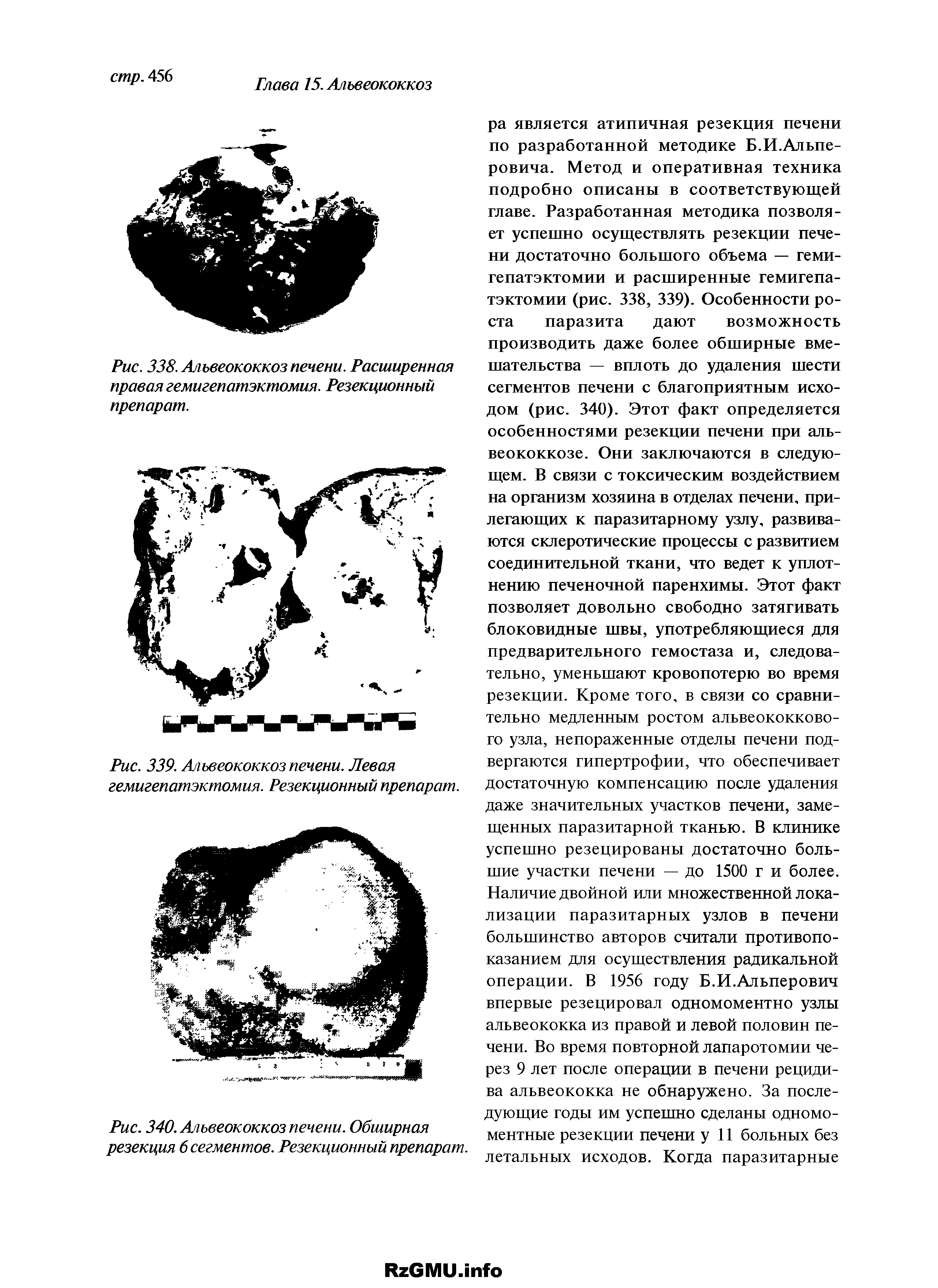 Рис. 339. Альвеококкоз печени. Левая гемигепатэктомия. Резекционный препарат.