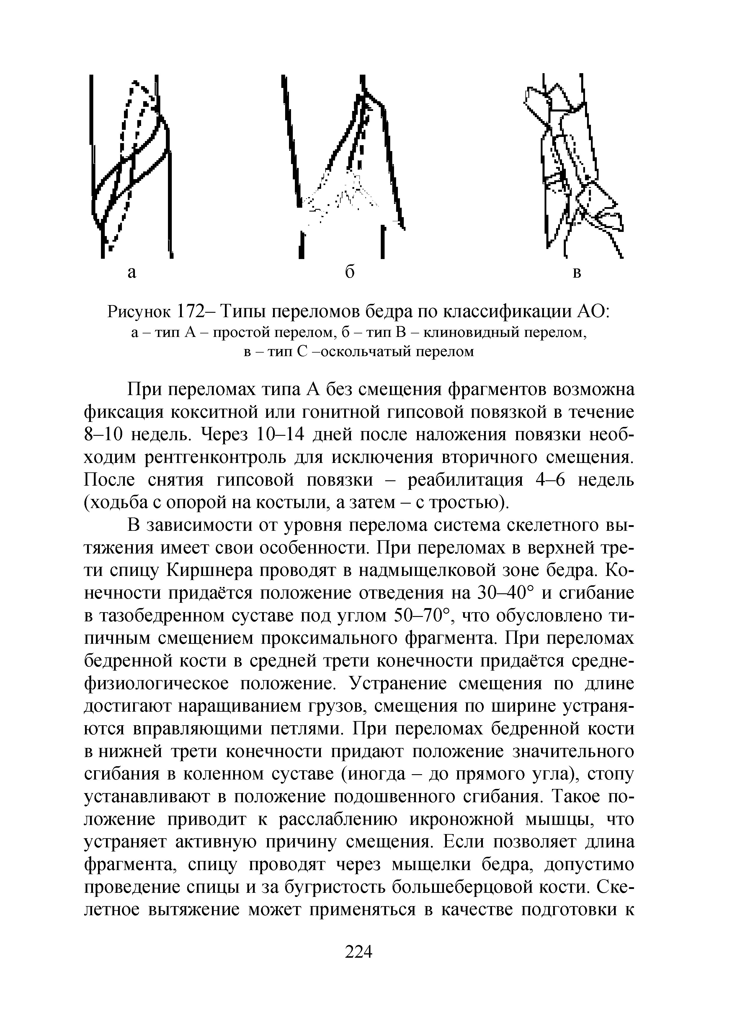 Рисунок 172- Типы переломов бедра по классификации АО а - тип А - простой перелом, б - тип В - клиновидный перелом, в - тип С -оскольчатый перелом...