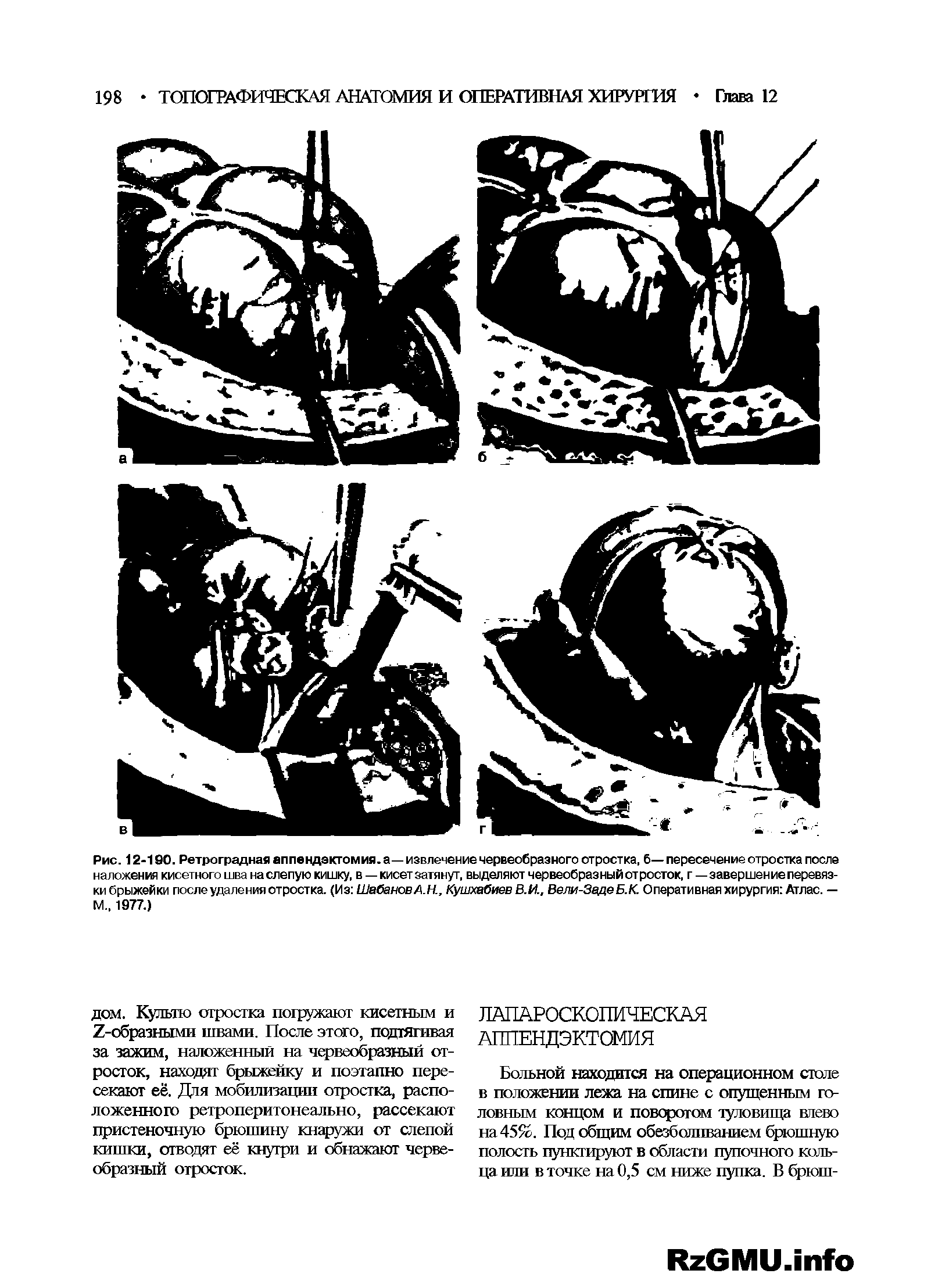 Рис. 12-190. Ретроградная аппендэктомия, а— извлечение червеобразного отростка, б— пересечение отростка после наложения кисетного шва на слепую кишку, в — кисет затянут, выделяют червеобразный отросток, г —завершение перевязки брыжейки после удаления отростка. (Из Шабанов А.Н., Кушхабиев В.И., Вели-ЗадеБ.К. Оперативная хирургия Атлас. — М 1977.)...